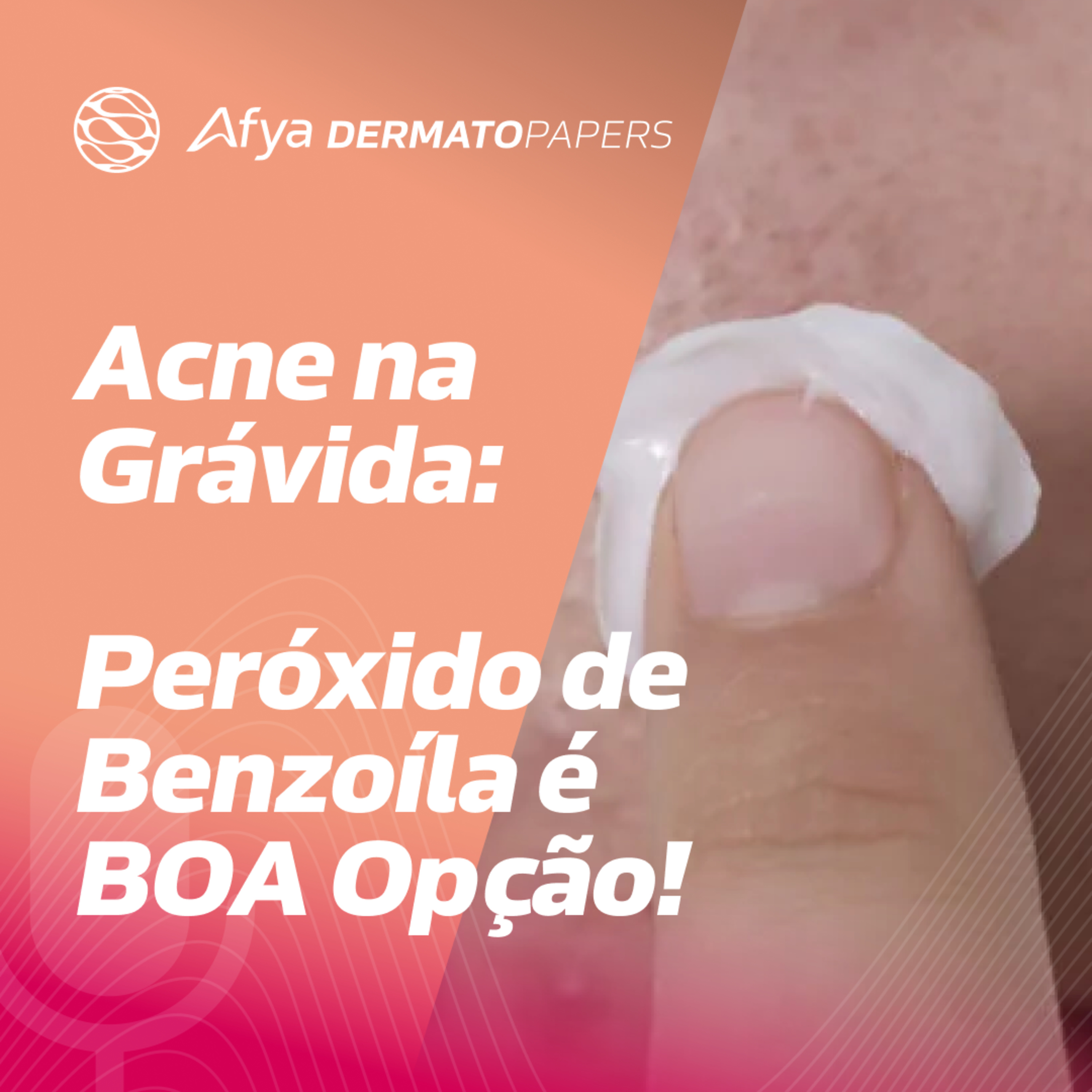 Peróxido de benzoíla: opção segura para acne na gravidez episode artwork