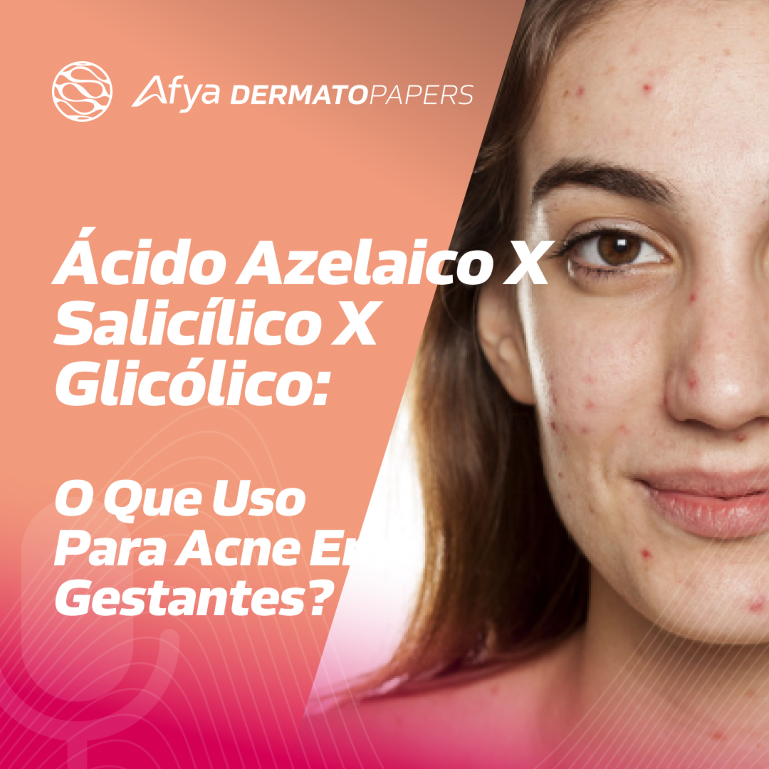 Ácidos tópicos para acne: o que posso usar em gestantes? episode artwork
