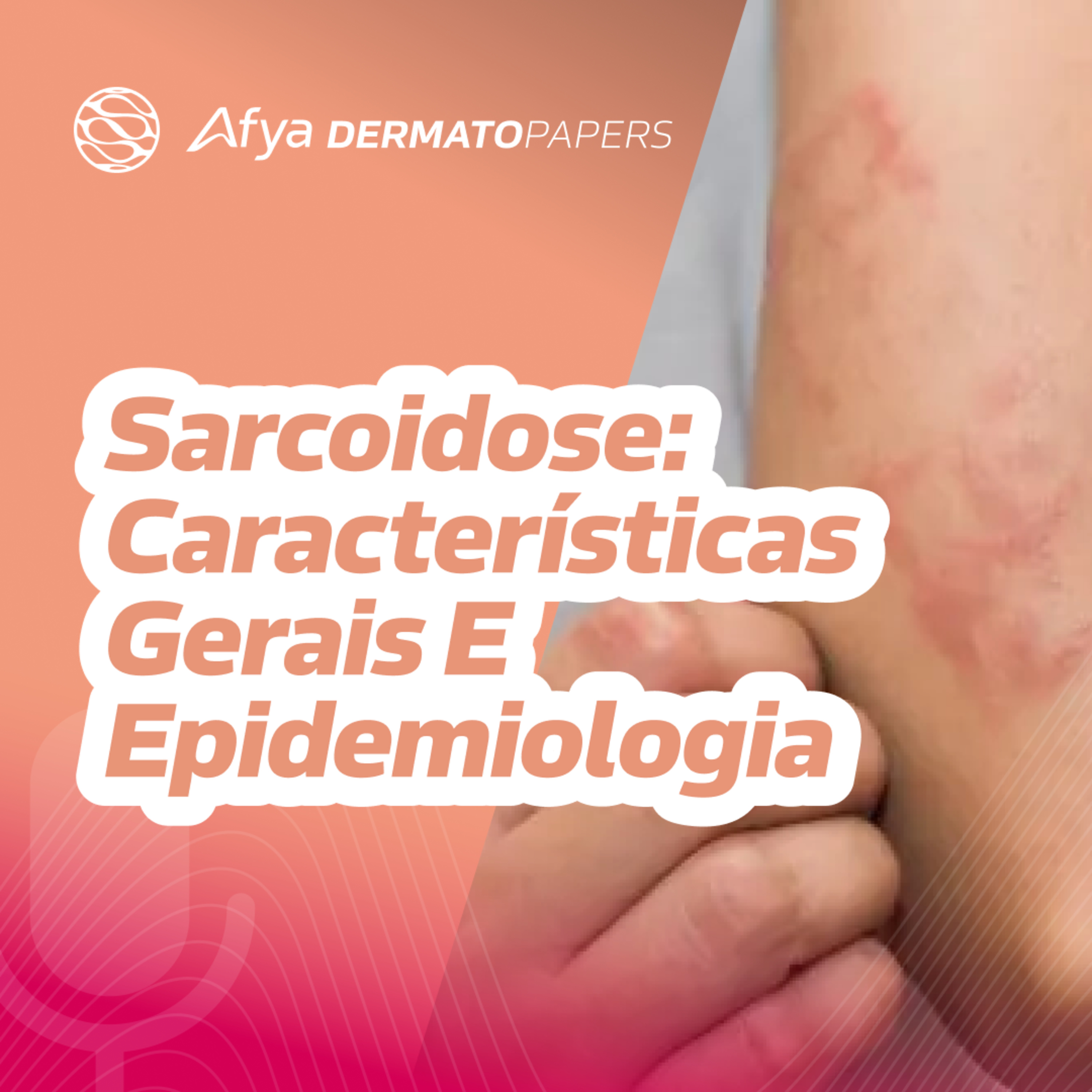 O que caracteriza a sarcoidose é e quem pode desenvolver a doença? episode artwork