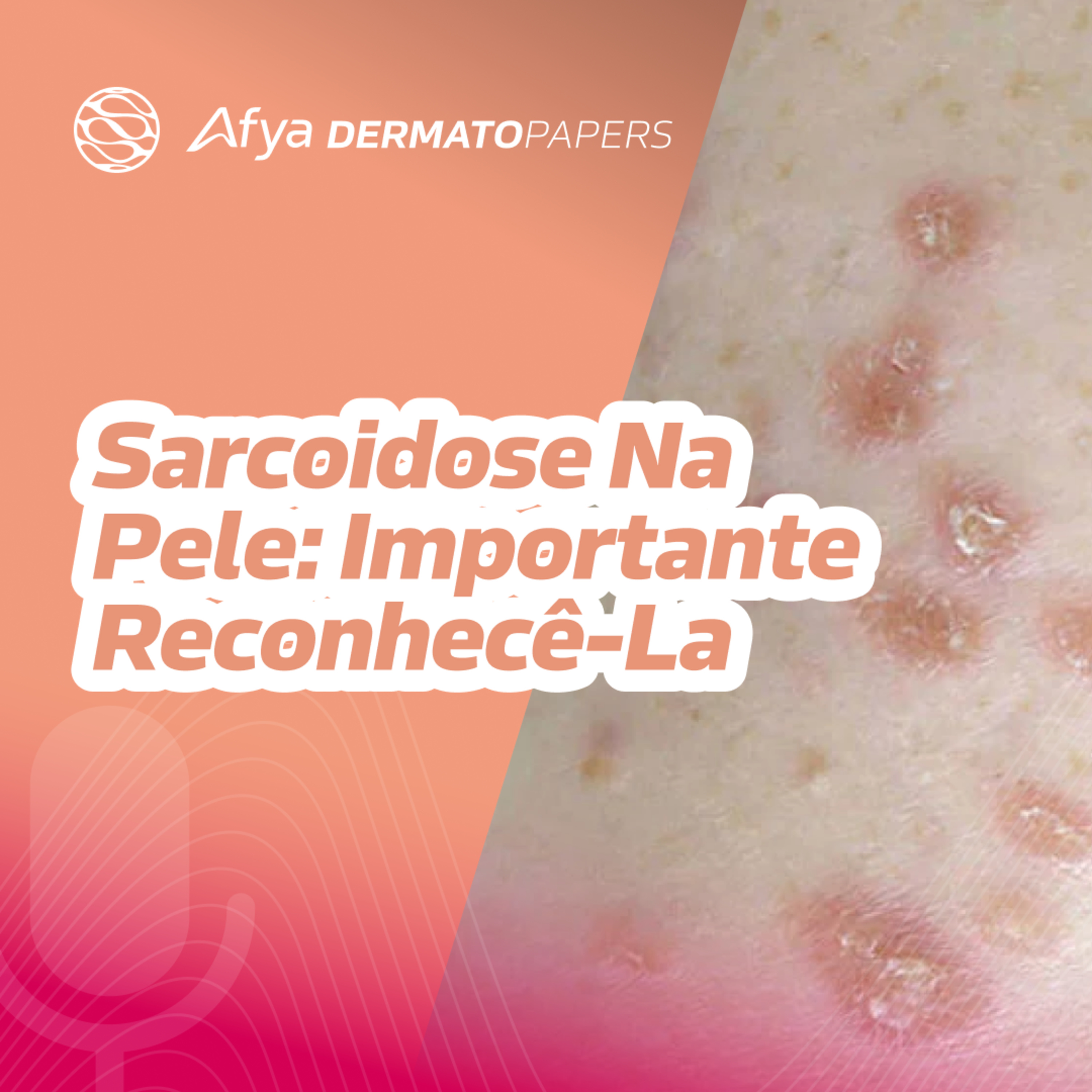 Por que é tão importante suspeitar e reconhecer a sarcoidose cutânea?  episode artwork