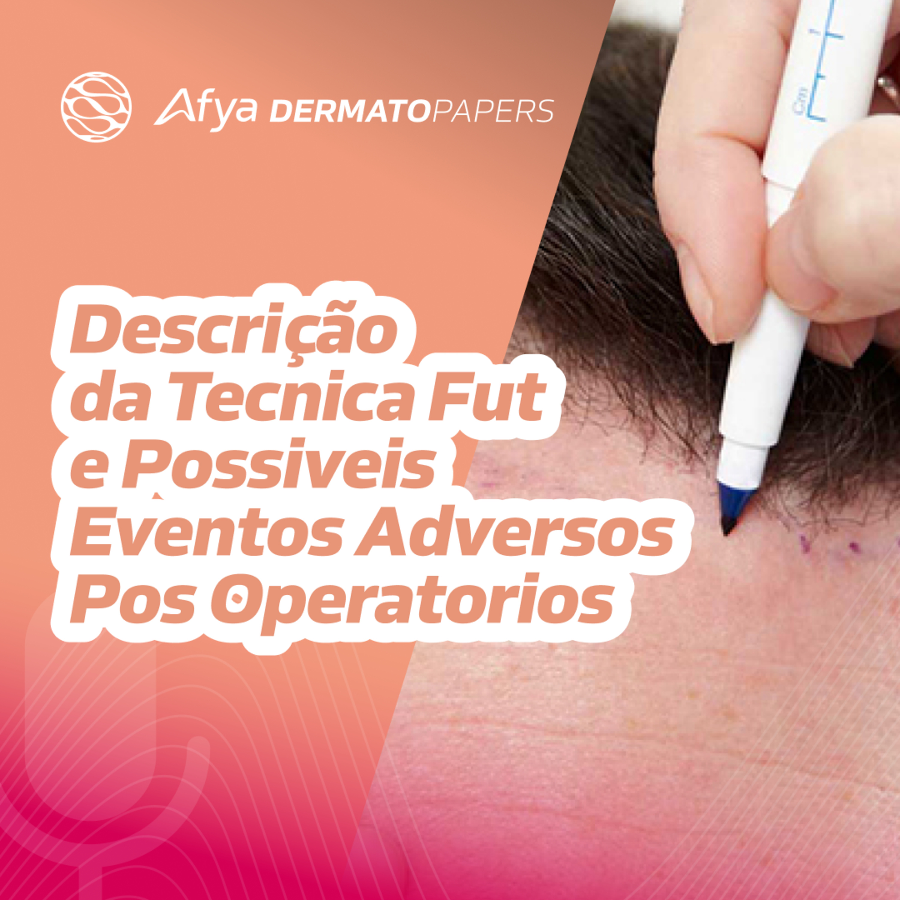 O que é a técnica FUT? Por que ele deixou de ser a mais usada atualmente ? episode artwork