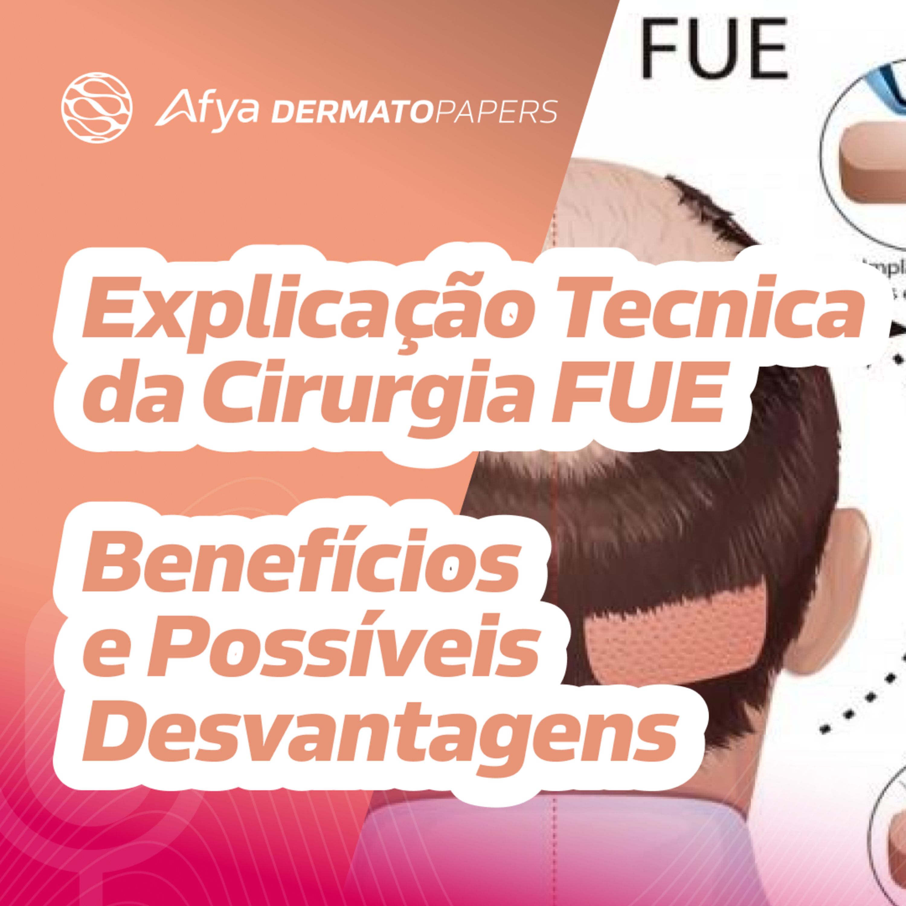 O que é a técnica FUE? Quais seus benefícios e desvantagens ? episode artwork