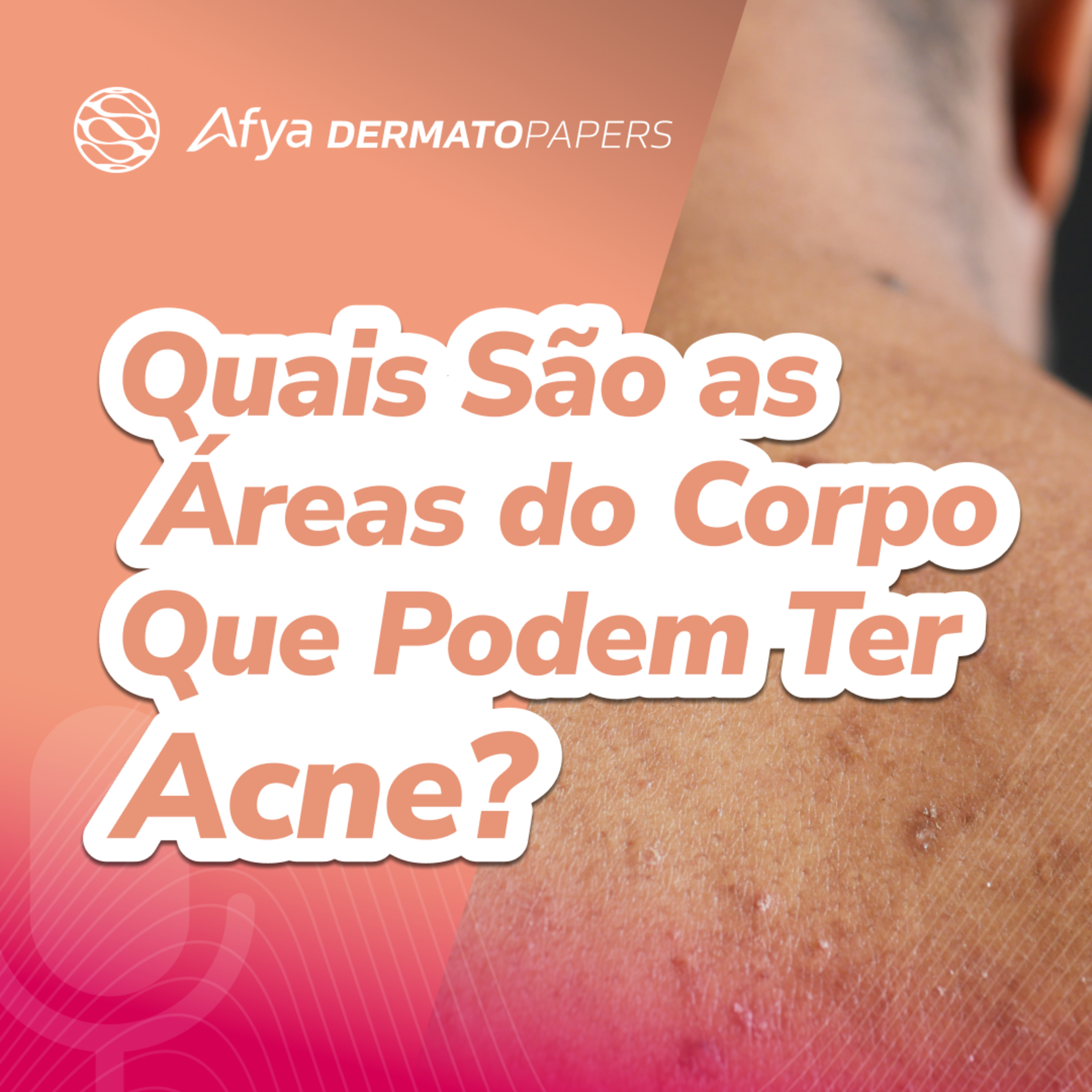 Quais são as áreas do corpo que podem ter acne? episode artwork