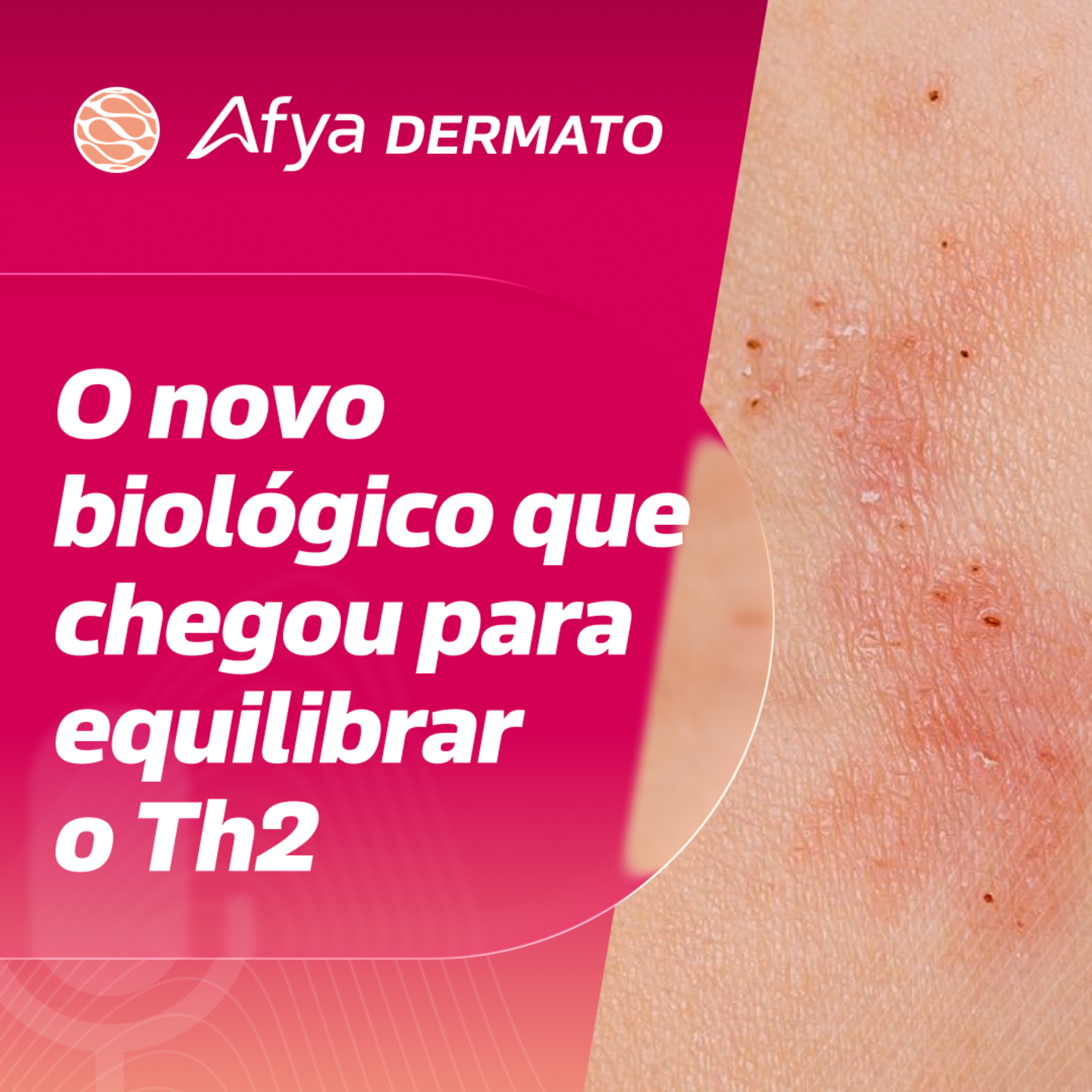 Lebrikizumab: bloqueando a IL-13 e redefinindo a resposta clínica episode artwork