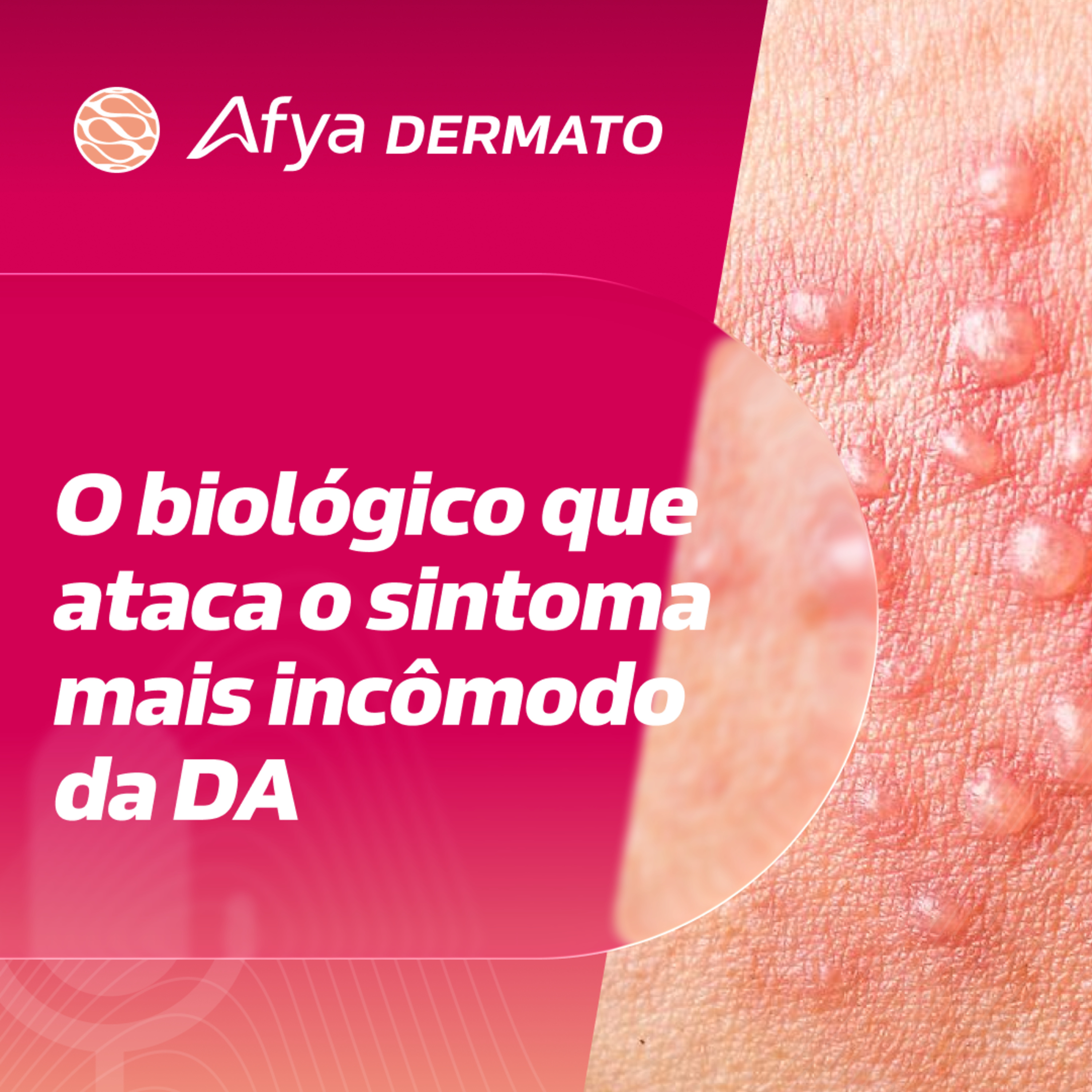 Nemolizumab e o foco no prurido: IL-31 em pauta episode artwork