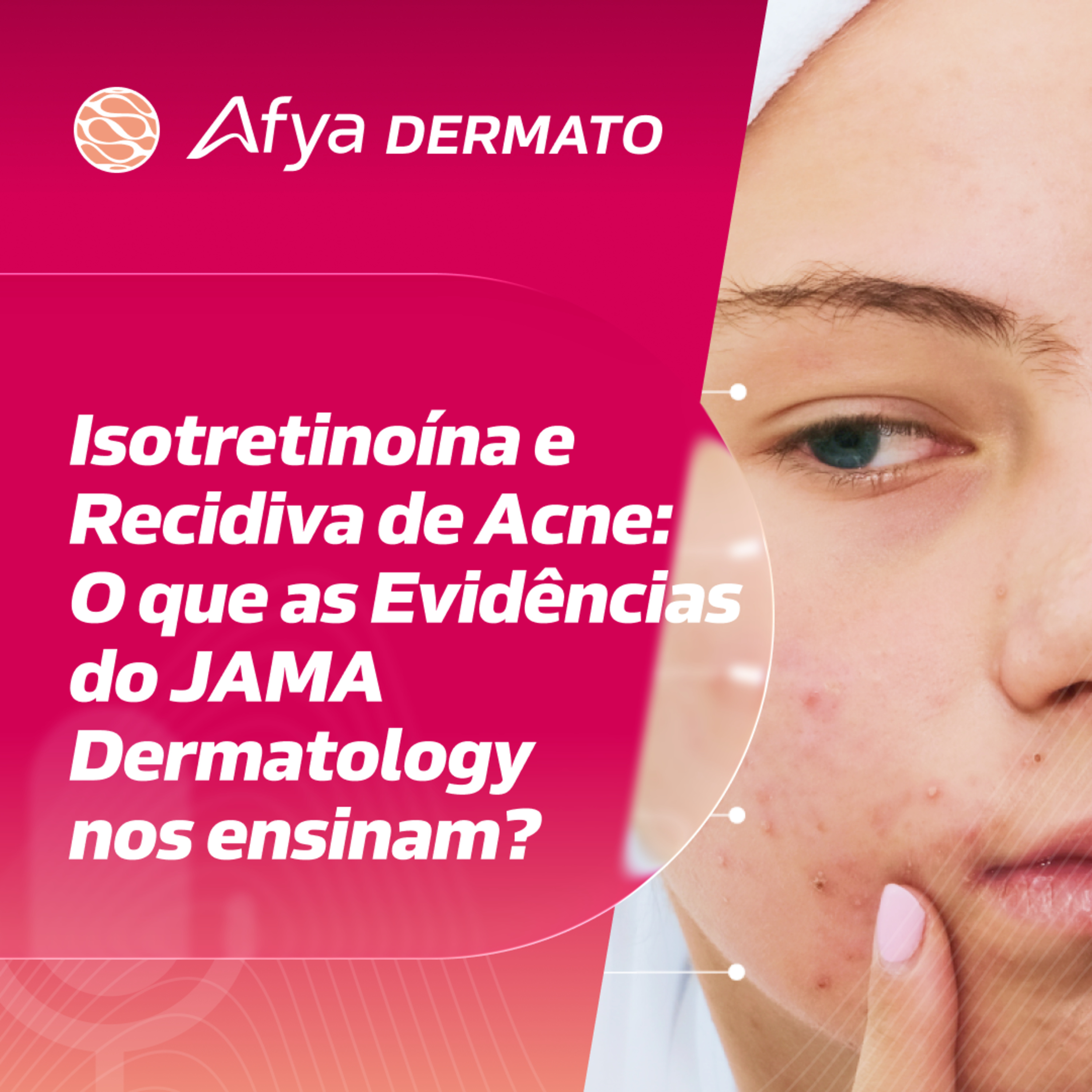 Isotretinoína e Recidiva de Acne: O que as Evidências do JAMA Dermatology nos ensinam? episode artwork