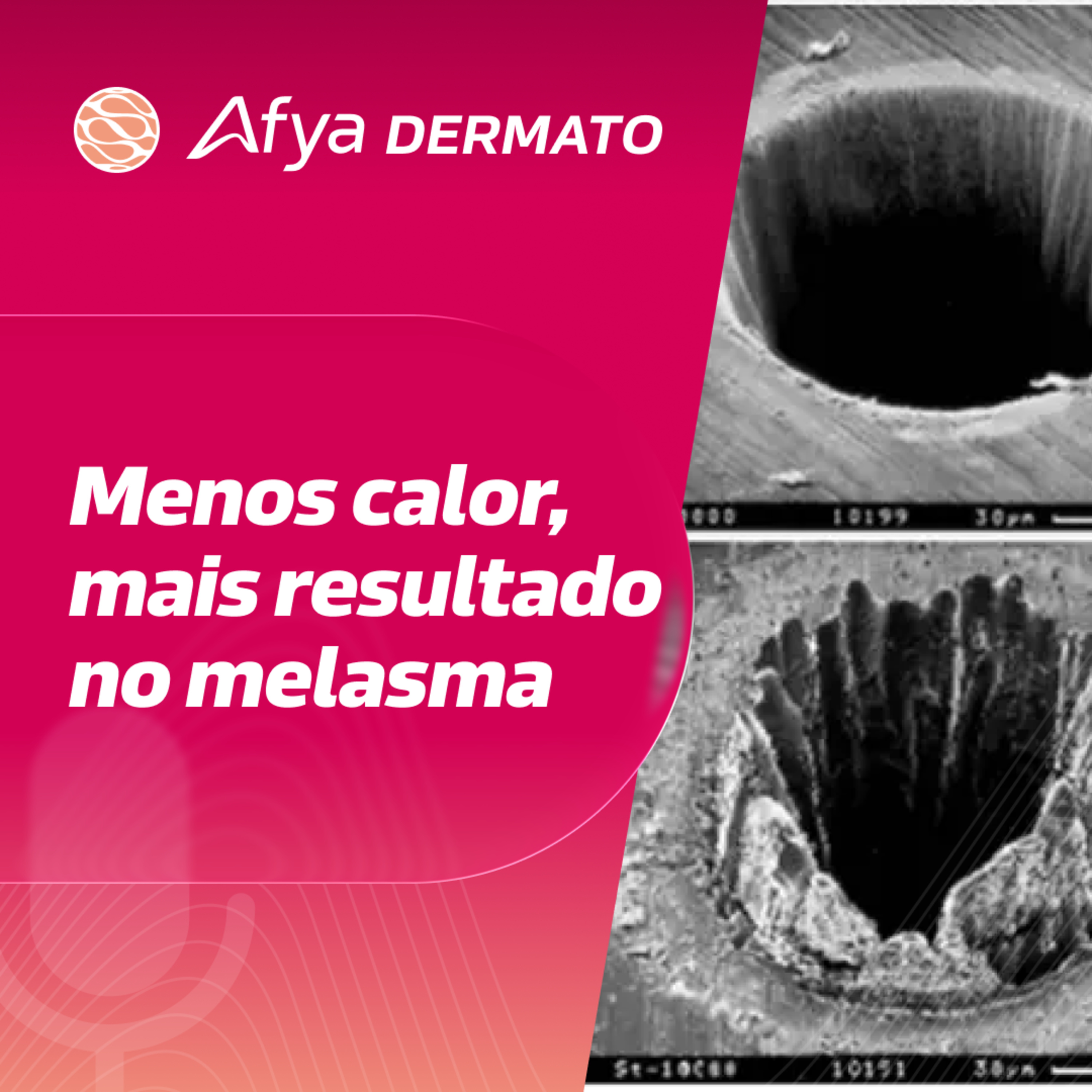 Por que o laser de picosegundos é superior no melasma de fototipos altos? episode artwork