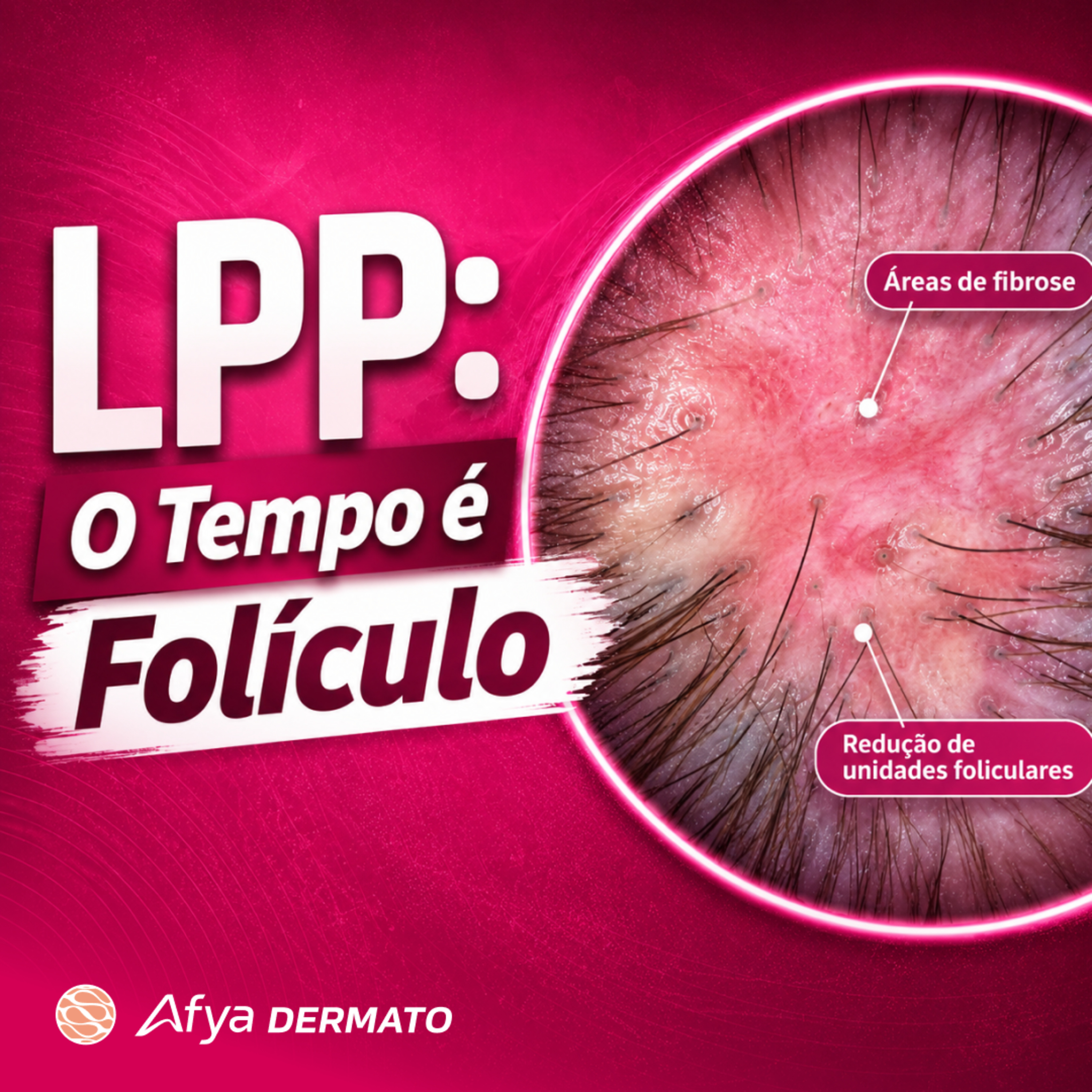 Emergência em Tricologia: O Manejo Agressivo do Líquen Planopilar (LPP). episode artwork