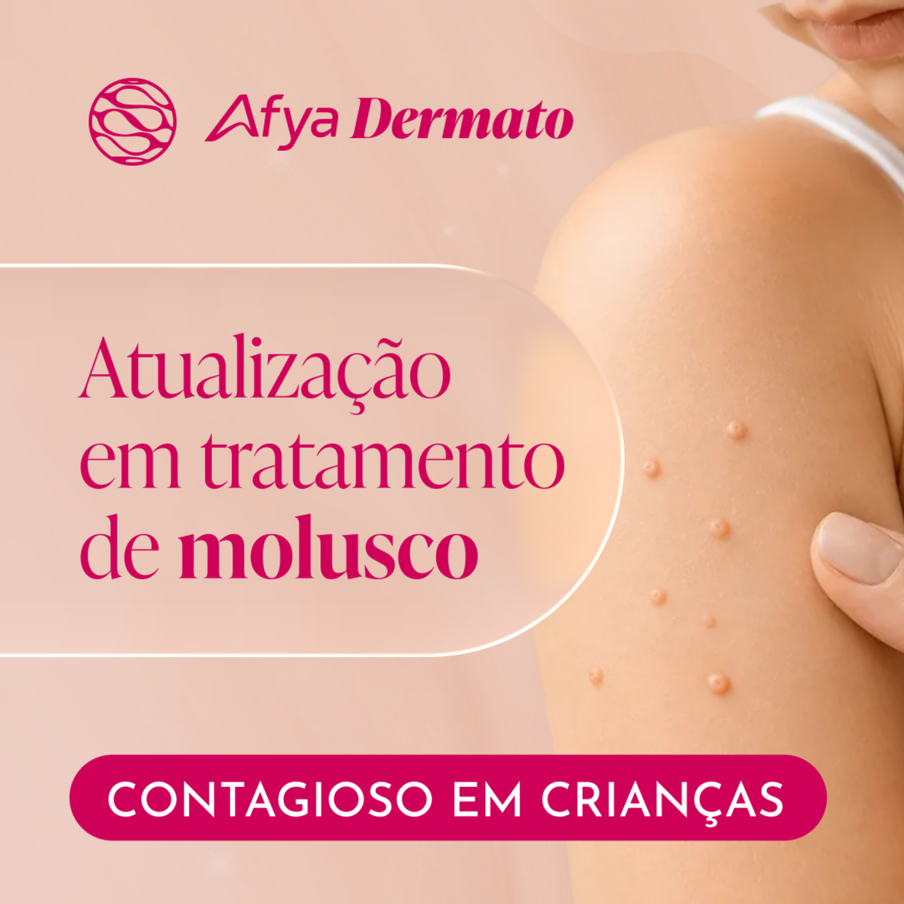 Atualização em tratamento de molusco contagioso em crianças episode artwork