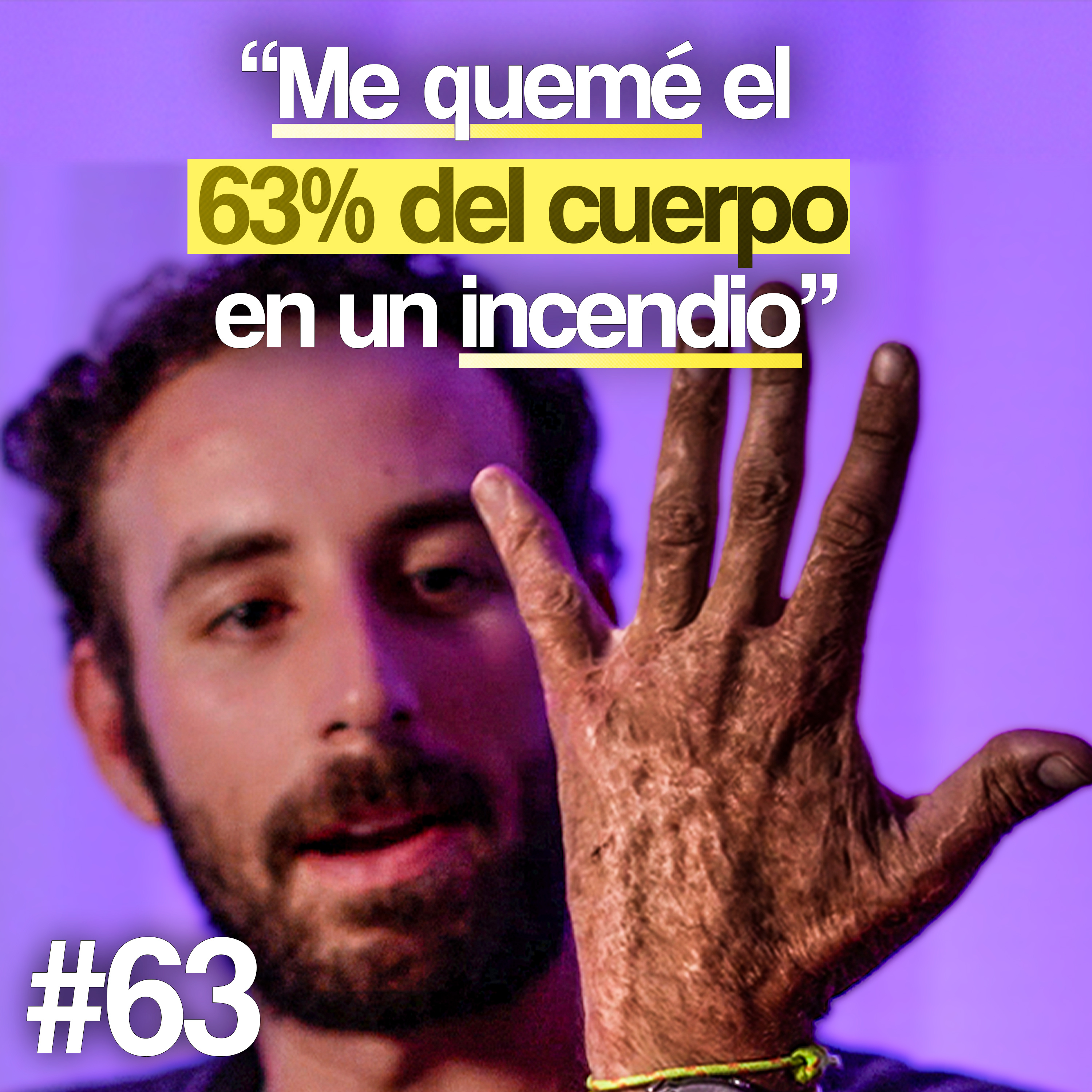 Llevo piel de laboratorio tras el incendio - Álvaro Trigo | Un Propósito #63