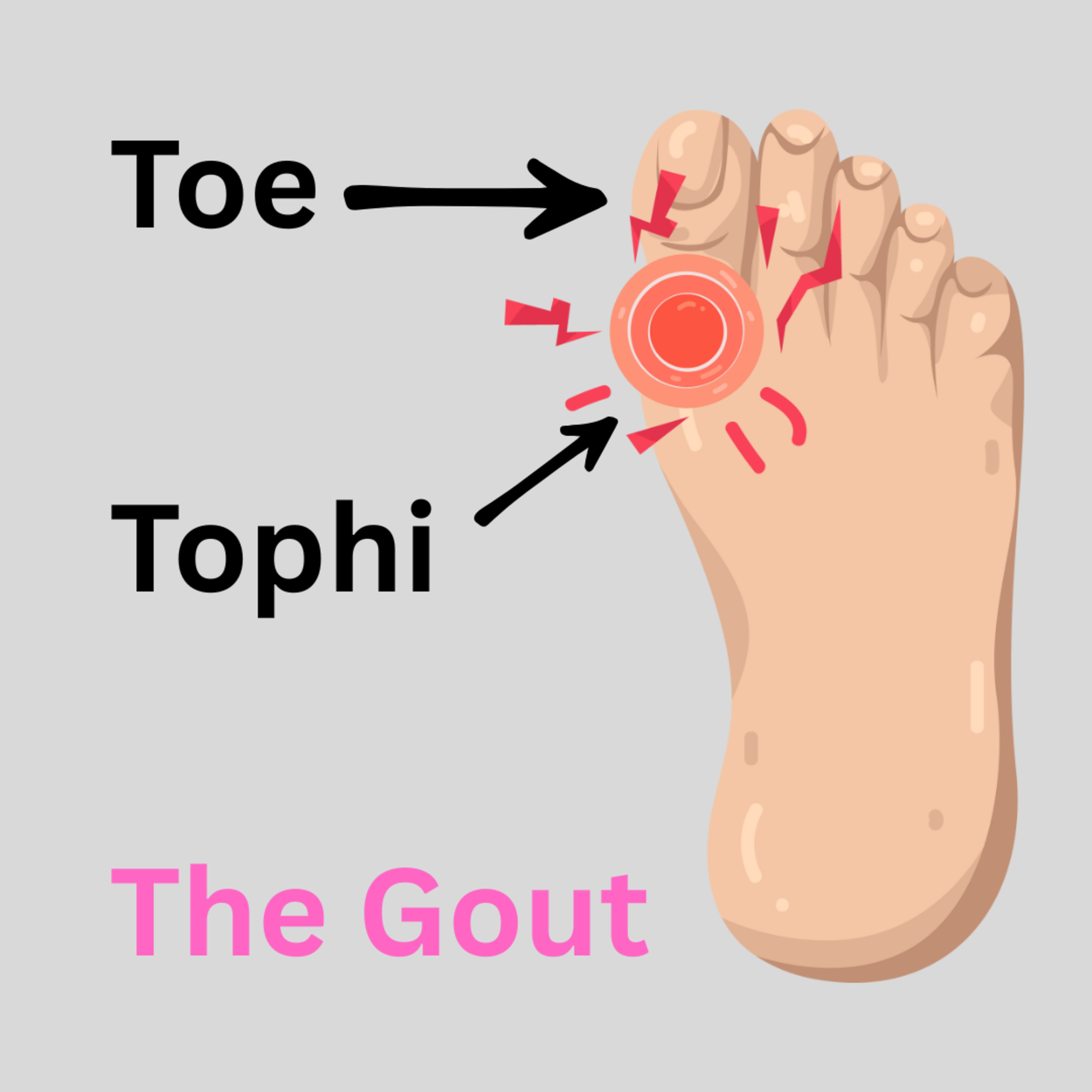 The Gout episode artwork