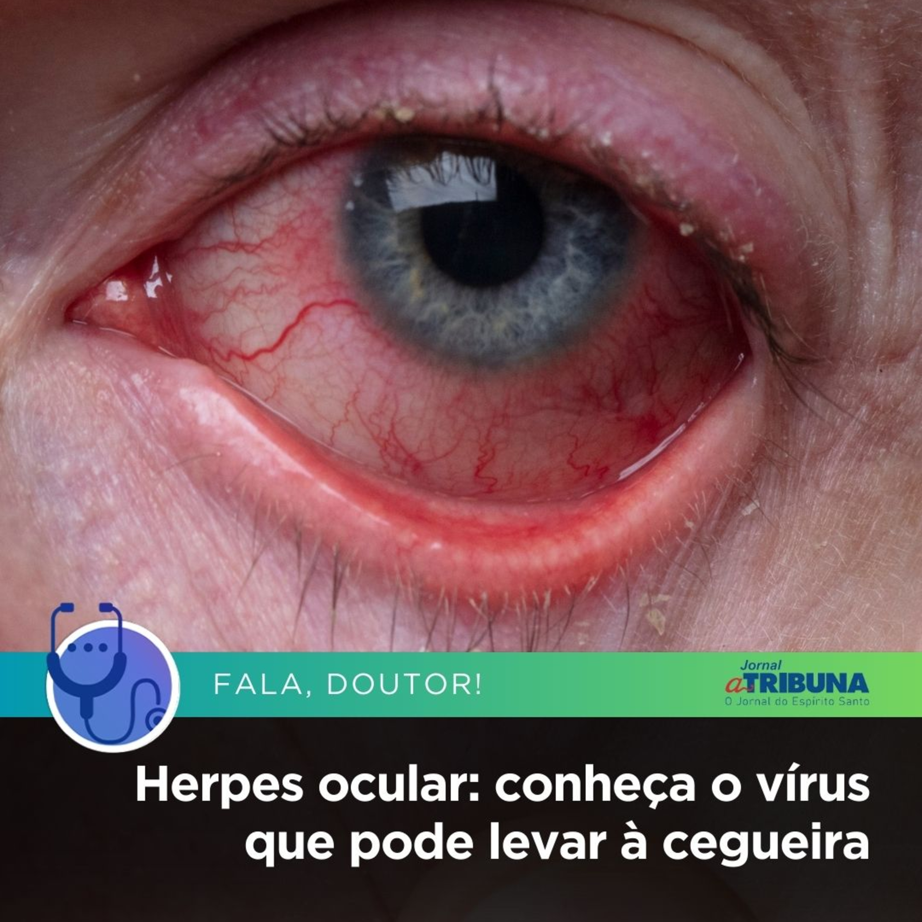 Herpes ocular: conheça o vírus que pode levar à cegueira | Fala, Doutora! episode artwork