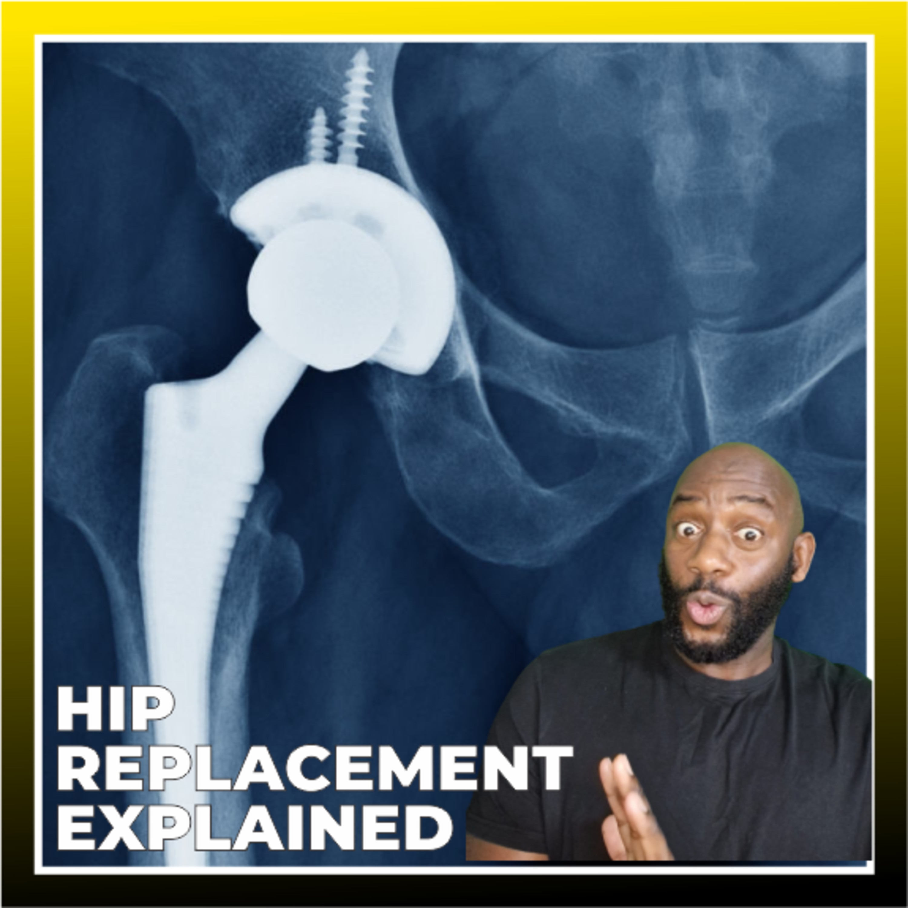 S09 E077 Hip replacement explained | Taxi Chronicles Podcast episode artwork