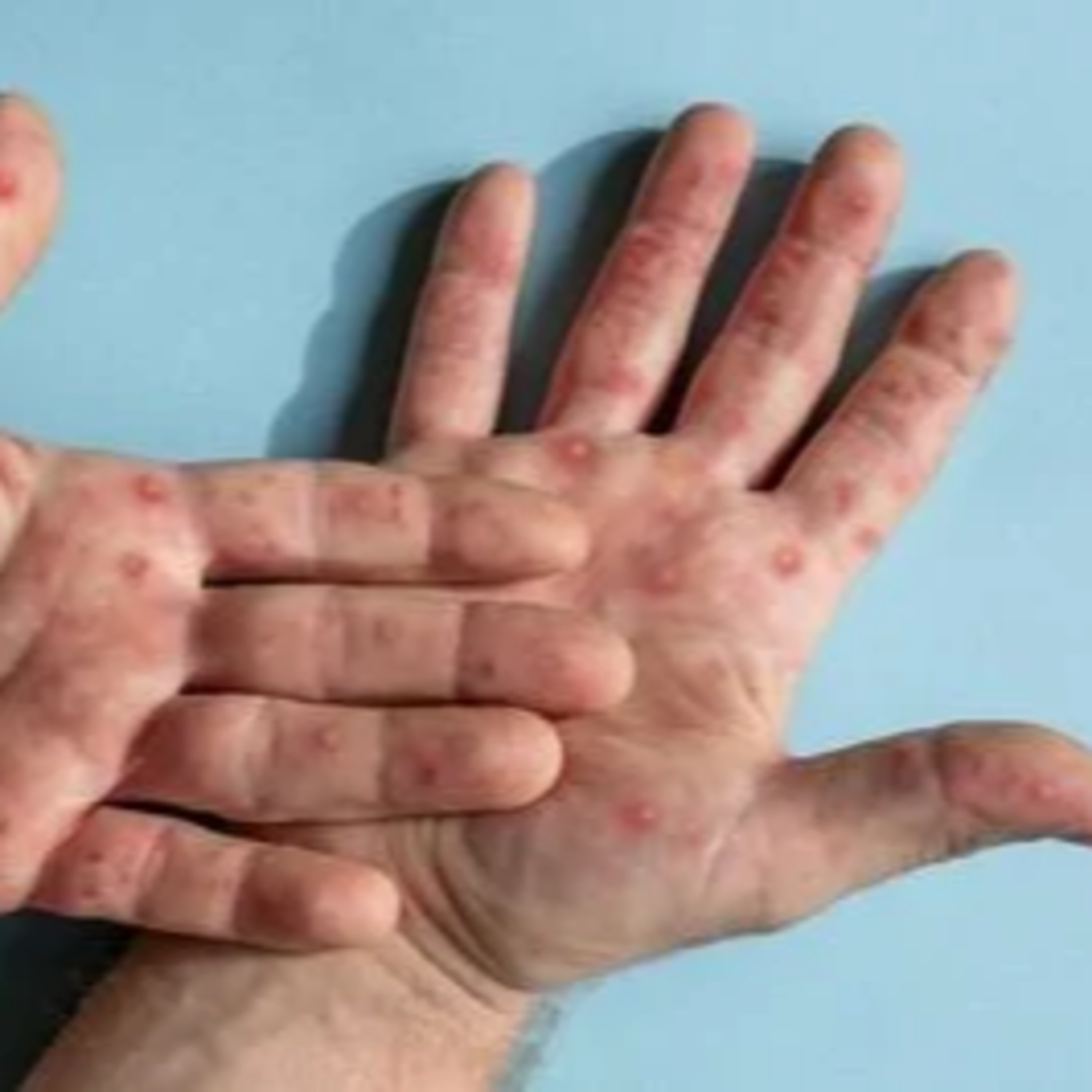 Emergência de saúde global: Sesa orienta para os cuidados com a Mpox episode artwork