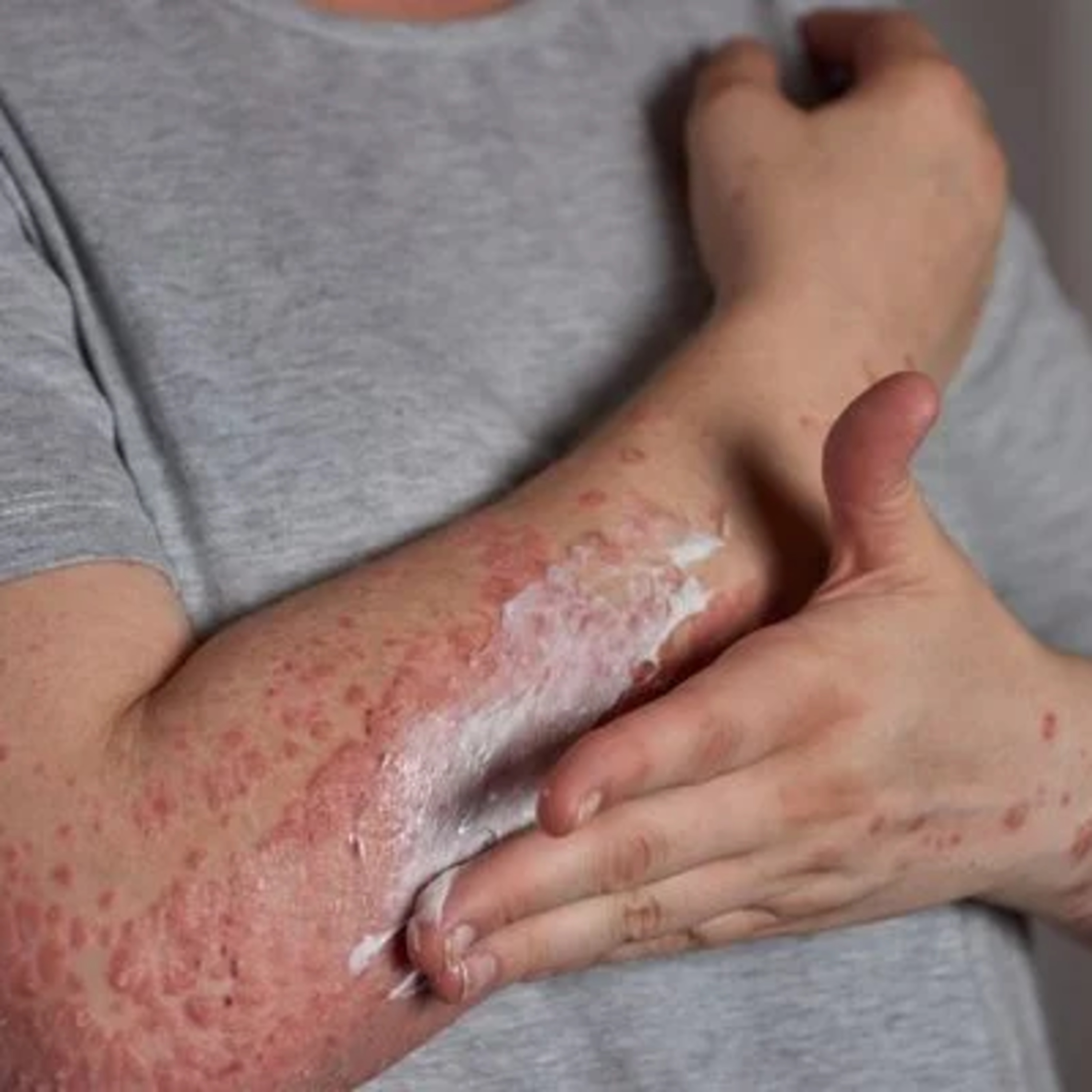 Tire suas dúvidas sobre a vacina para herpes-zósters! episode artwork