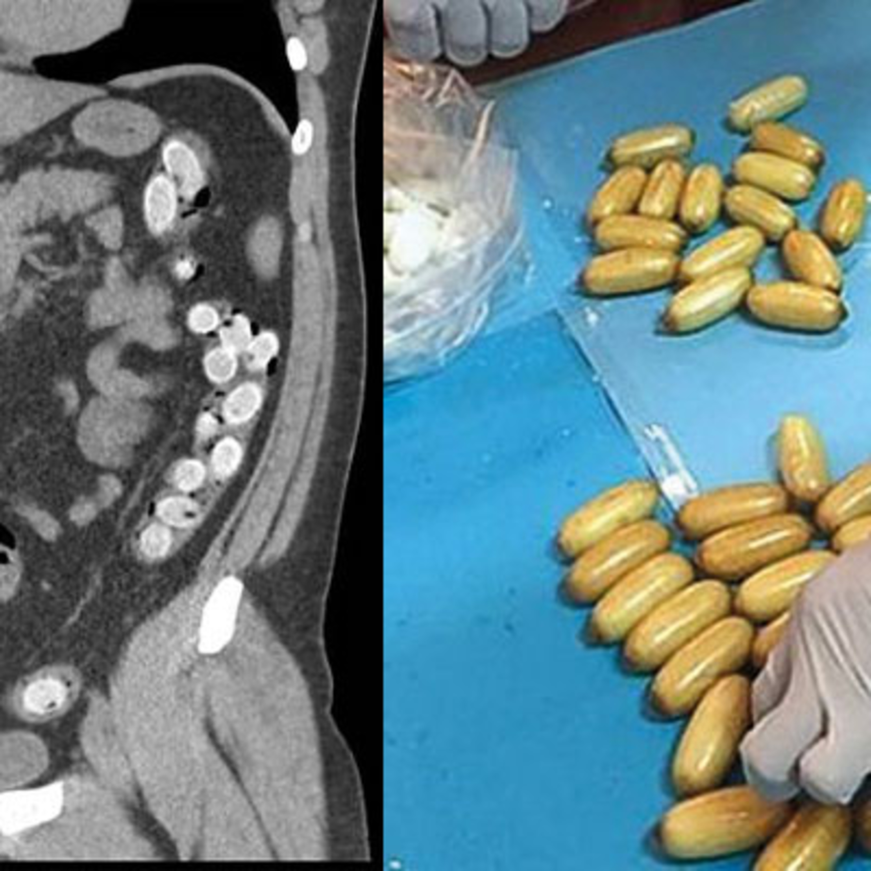 Gastrointestinal Yabancı Cisimler: Acil Yaklaşım