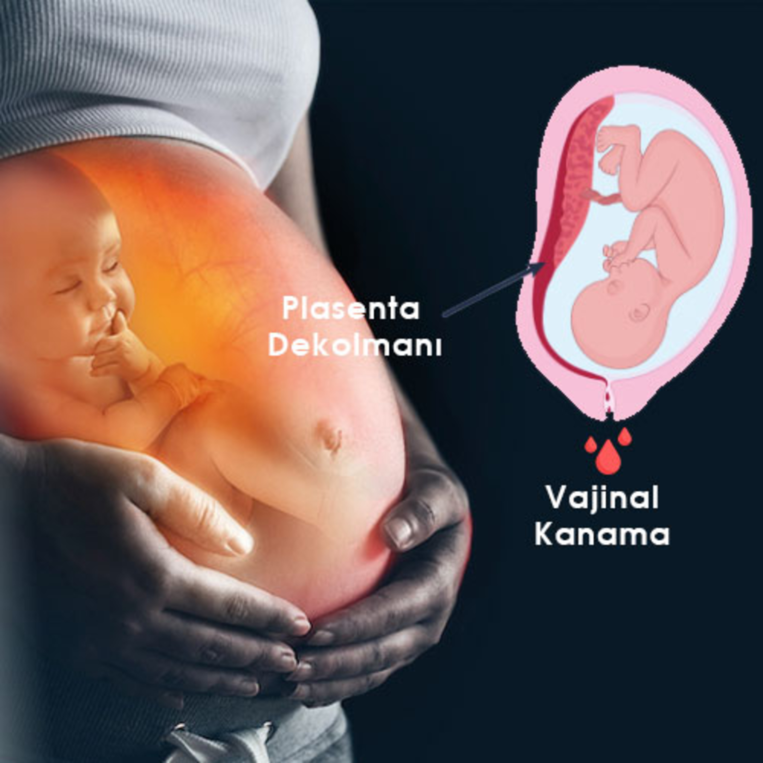 Ablasyo Plasenta (Plasenta Dekolmanı) | Acil Yaklaşım episode artwork