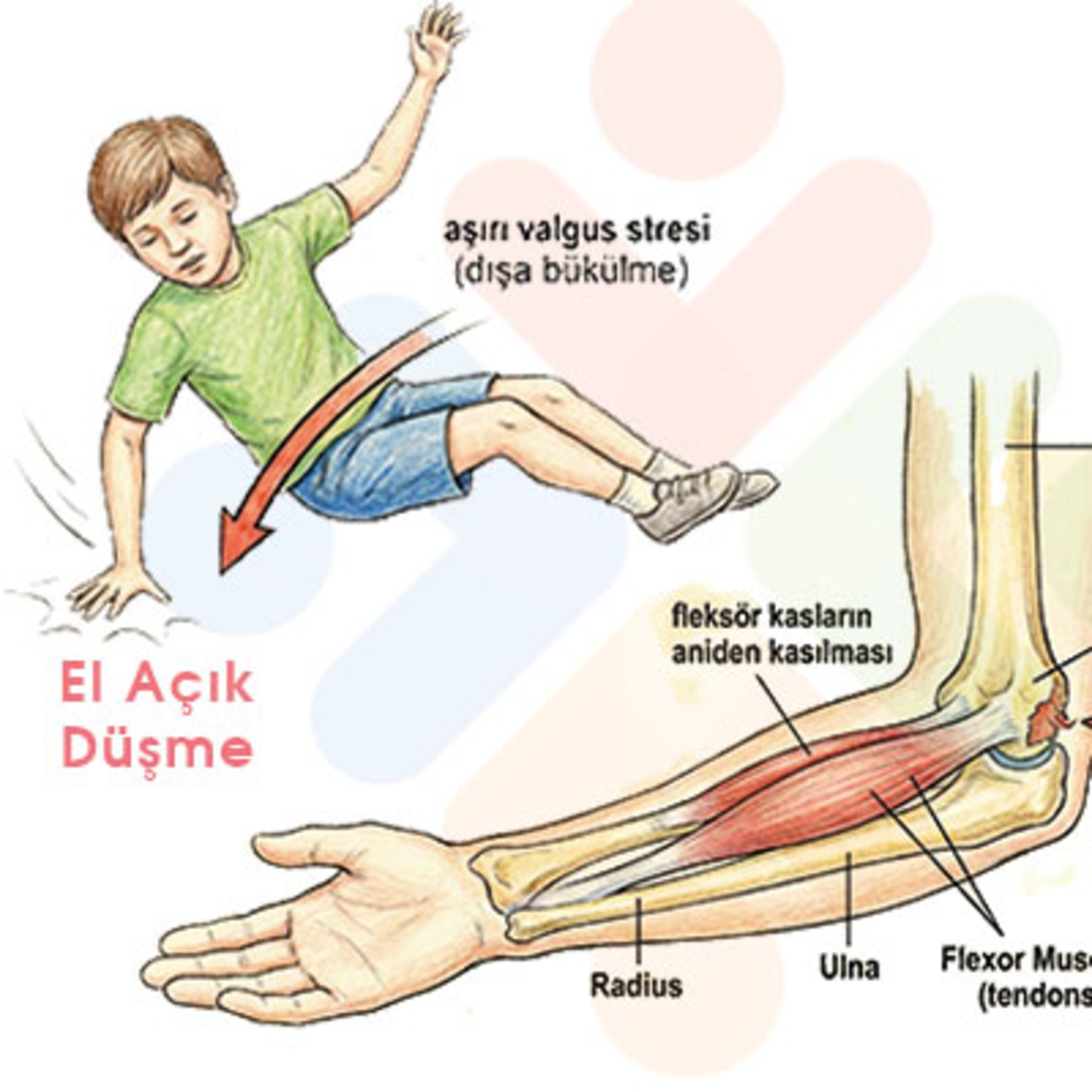 Medial Epikondil Avulsiyon Kırığı – Acil Serviste Tanı ve Yönetim İpuçları