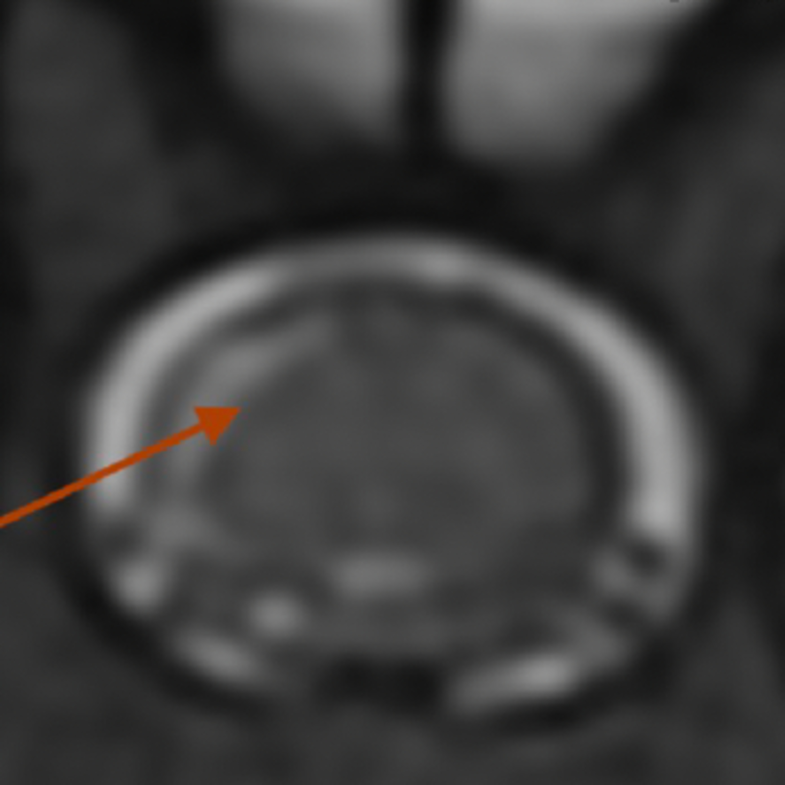Steroid-responsive meningitis-arteritis and MRI episode artwork