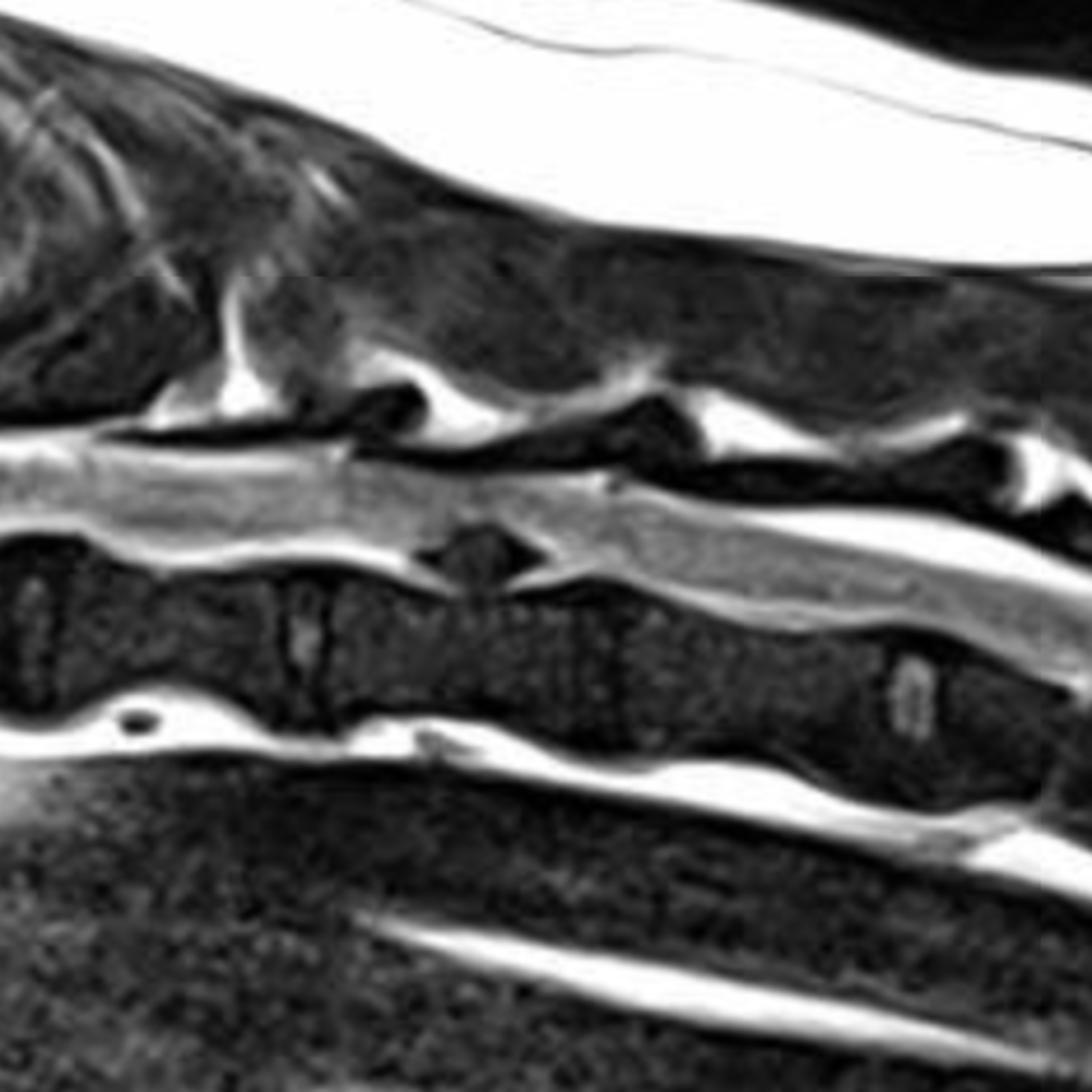 MRI of intradural/extramedullary intervertebral disc extrusion episode artwork