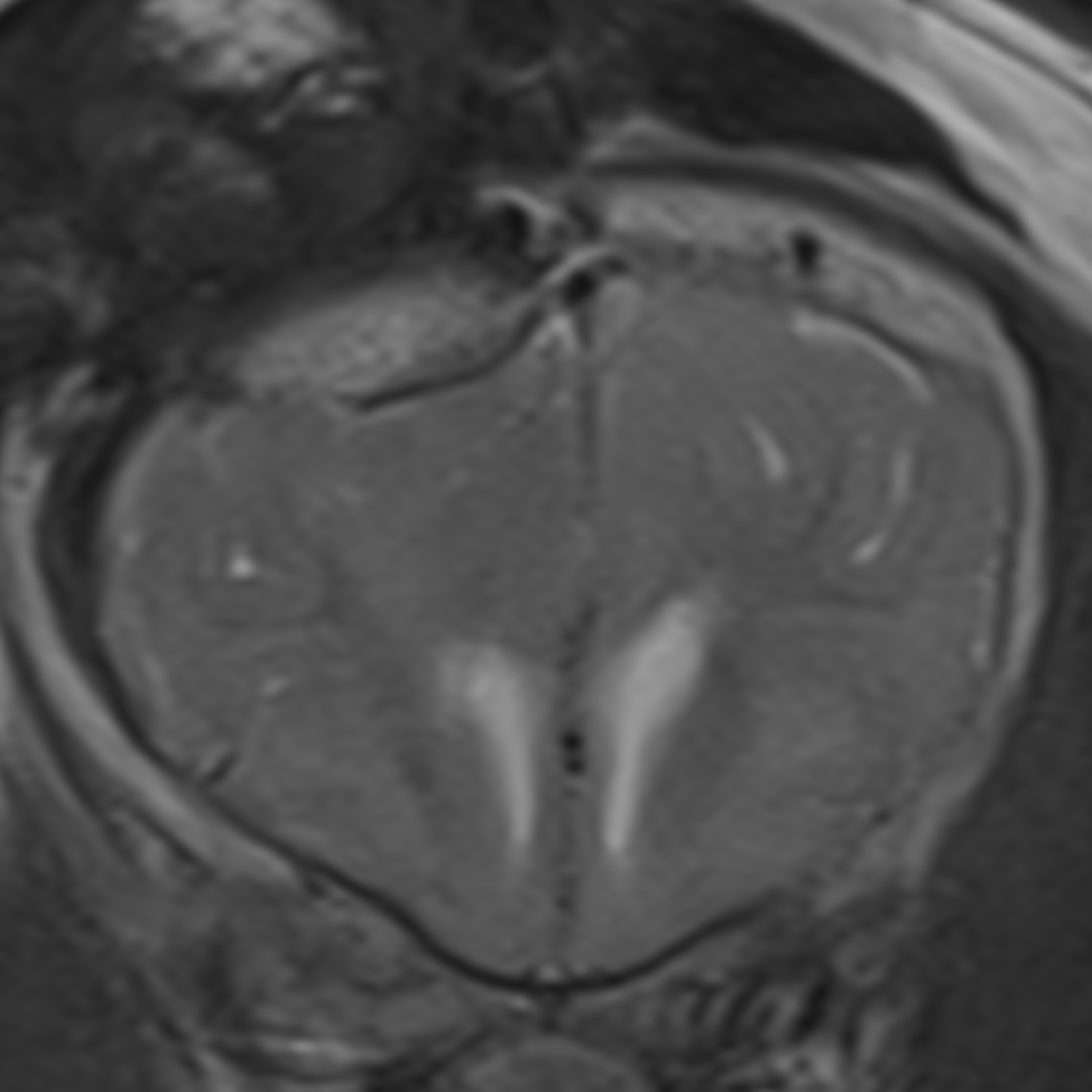 MRI and CT of Skull Fractures episode artwork