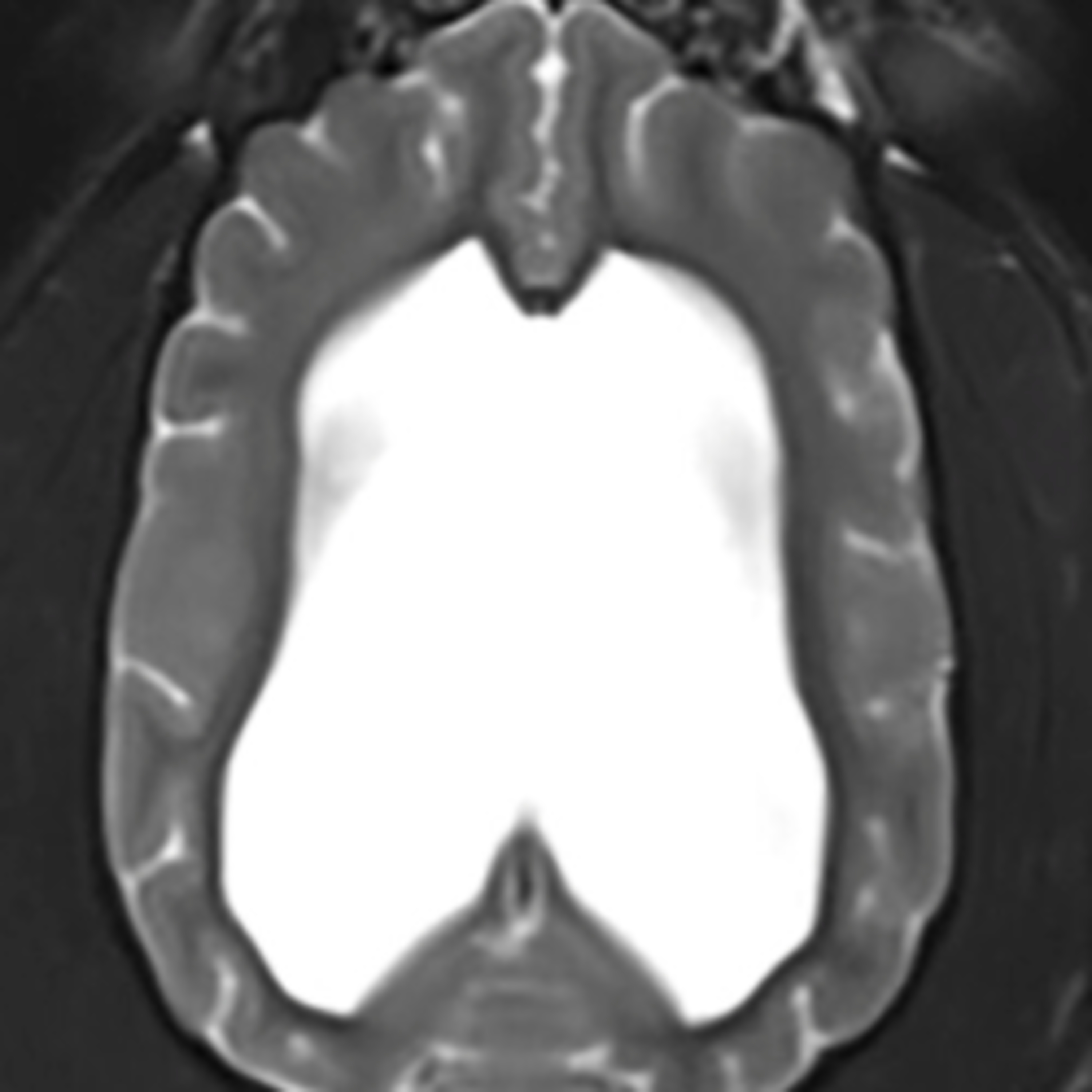 Risk factors, treatment, and outcome associated with ventriculoperitoneal shunting in dogs and cats episode artwork