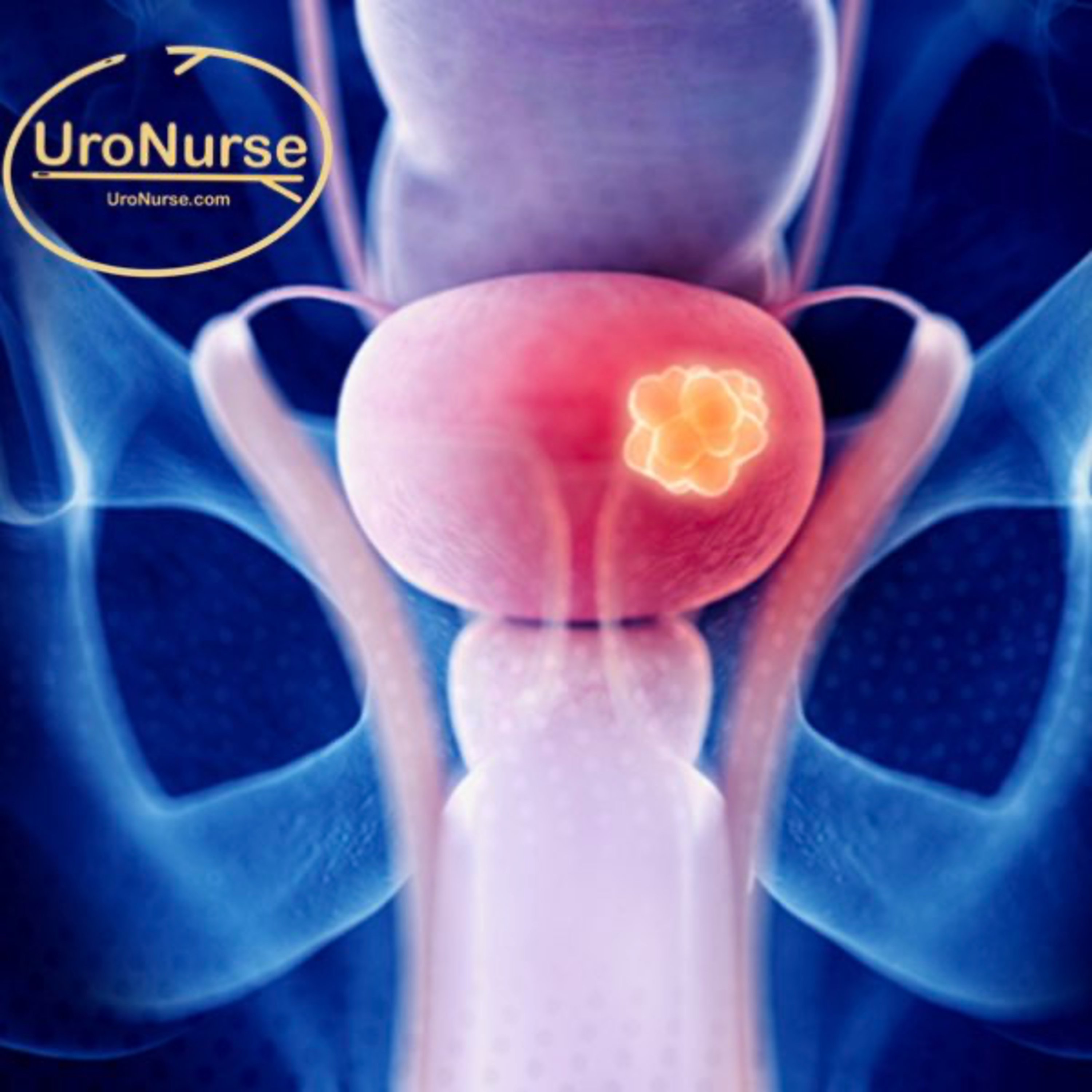 UroNurse