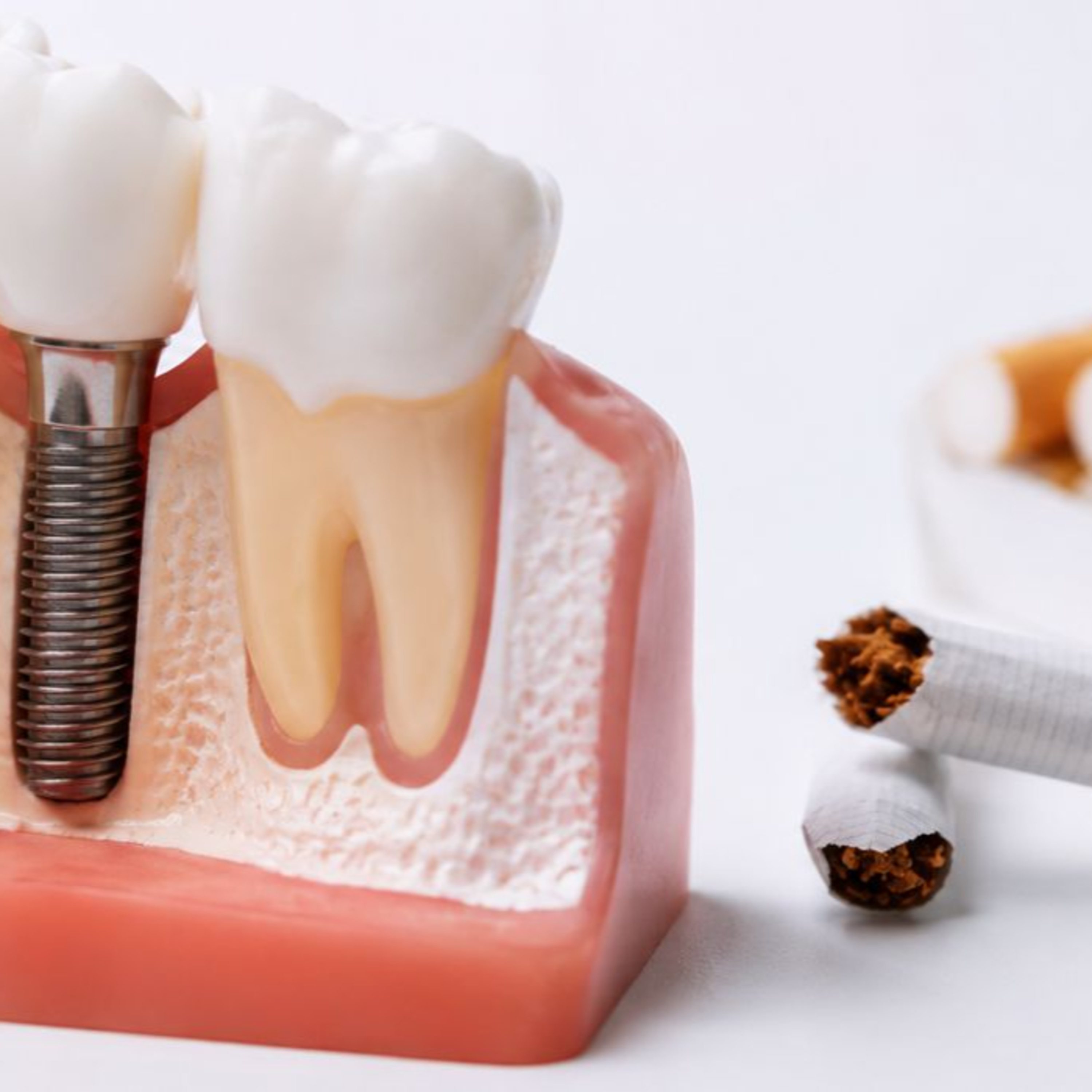 Cigarro pode comprometer implantes dentários? Especialista explica os riscos. episode artwork