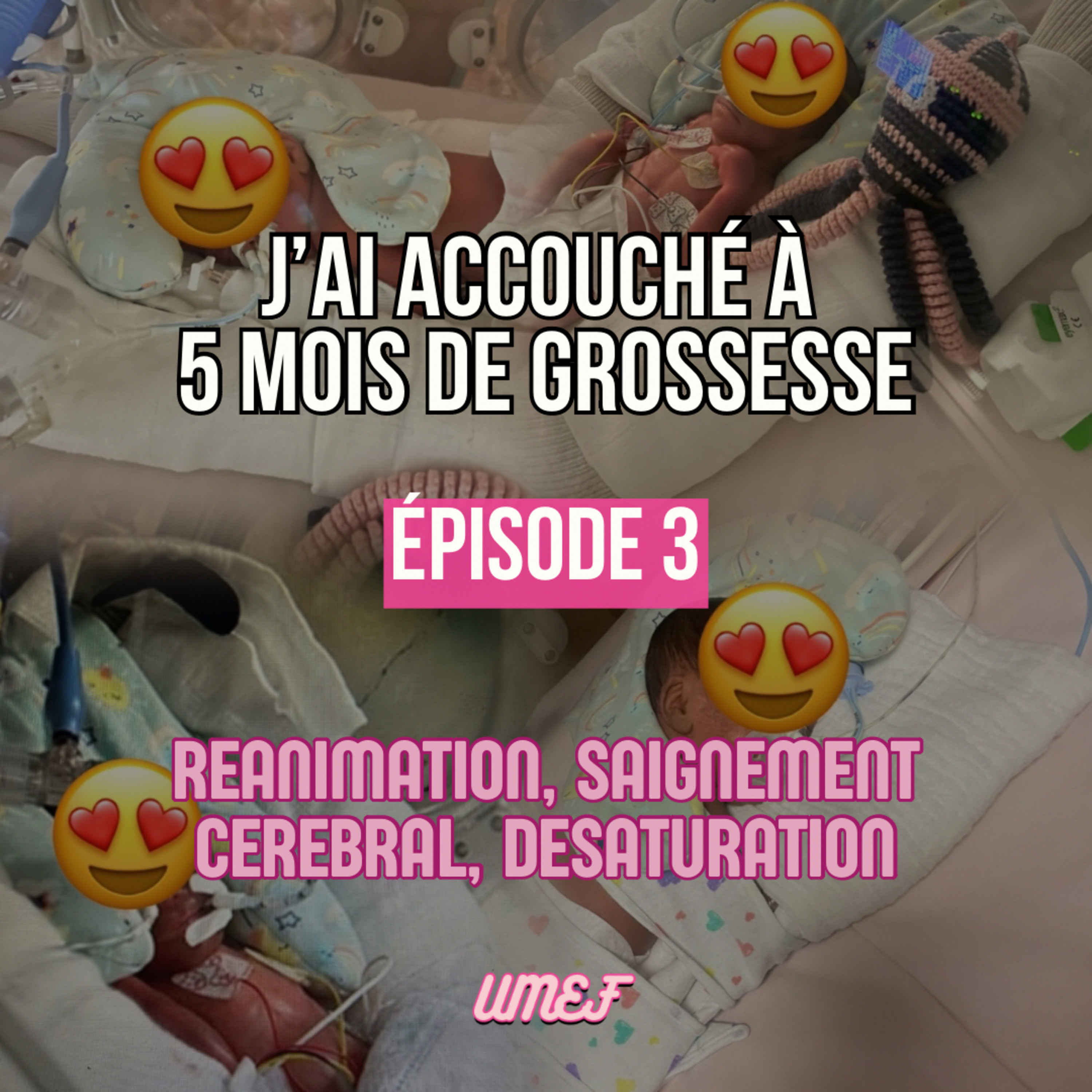 J’ai accouché à 5 mois de grossesse partie 3 : Réanimation, saignement cérébral, désaturation episode artwork