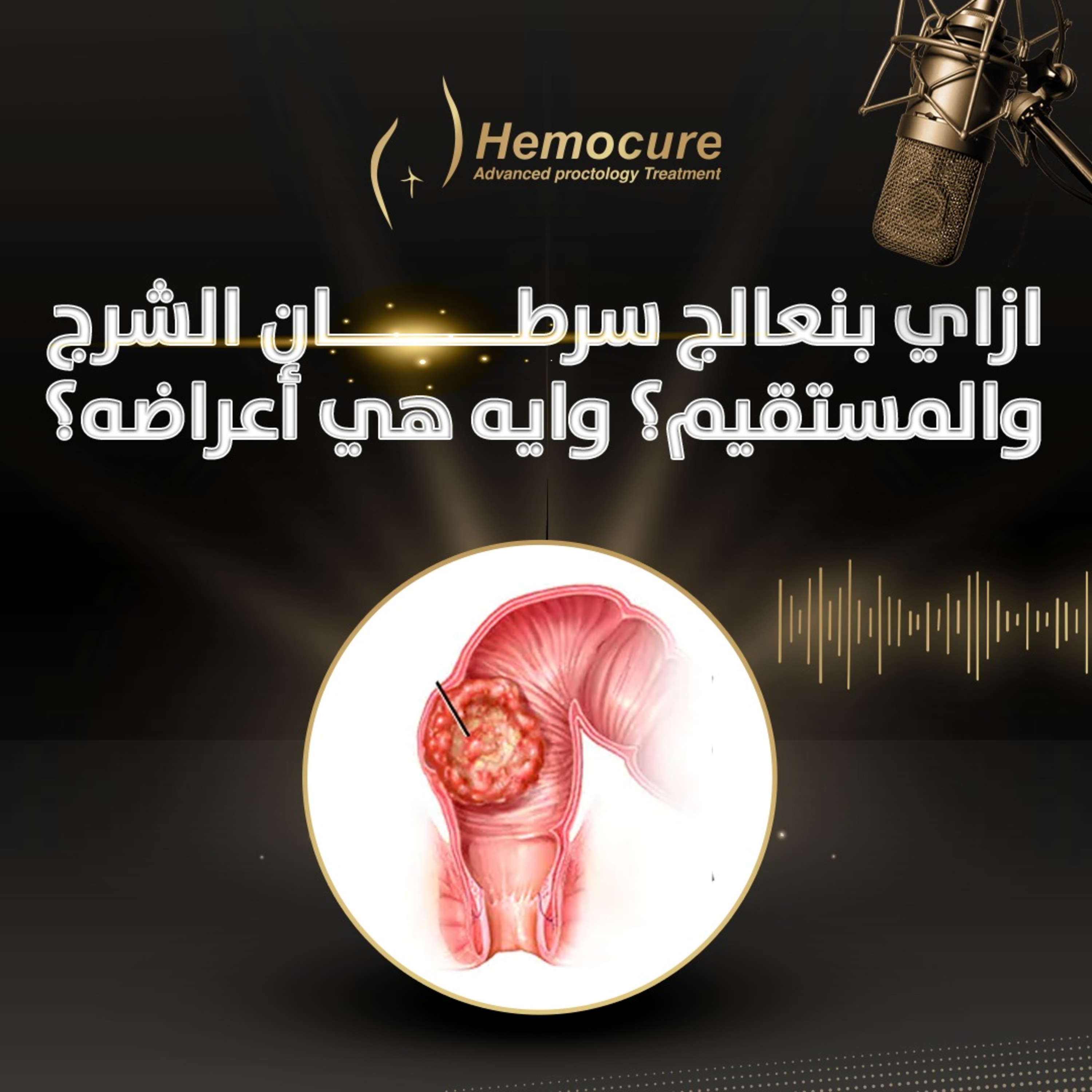 ازاي بنعالج سرطان الشرج والمستقيم؟ وايه هي أعراضه؟