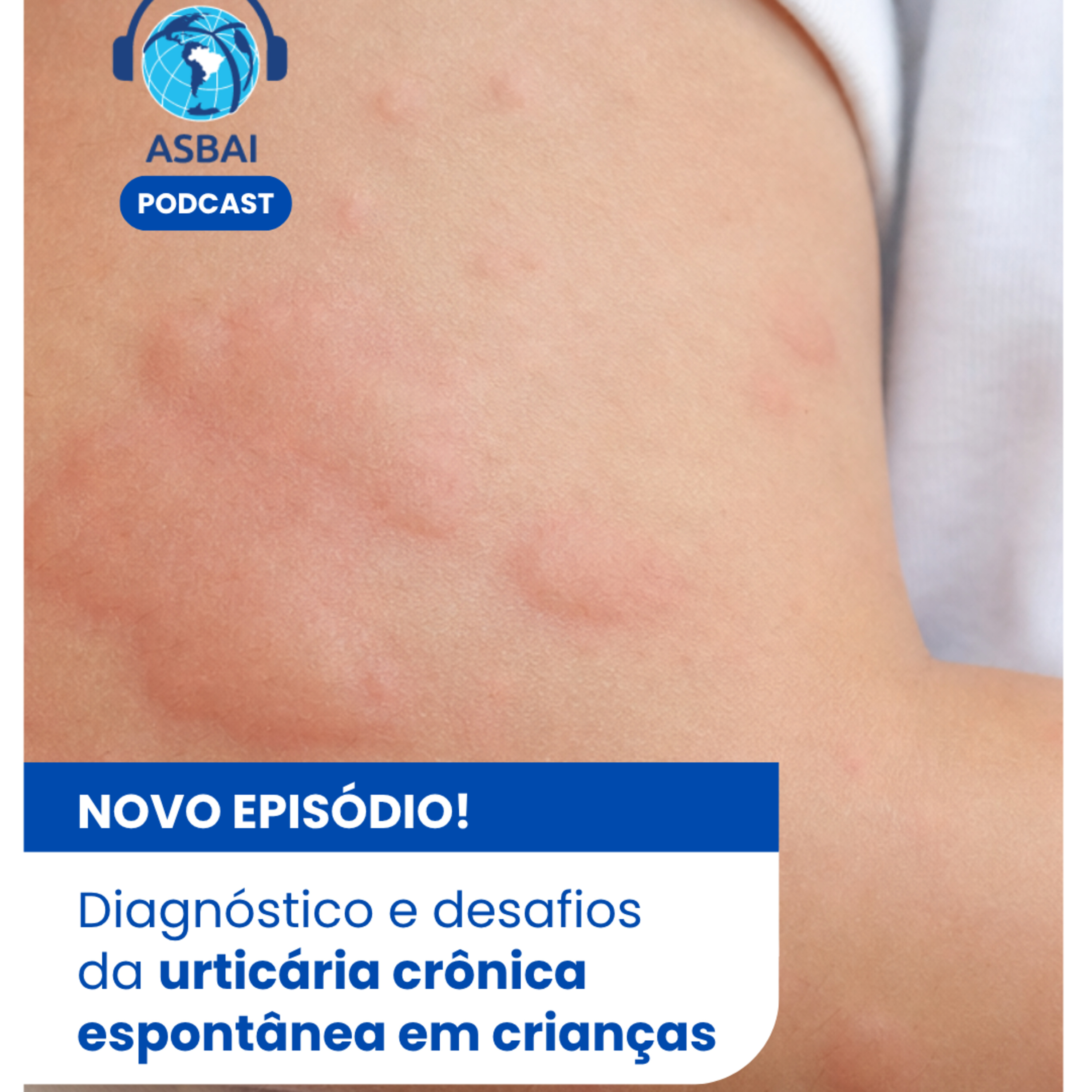 Diagnóstico e desafios da urticária crônica em crianças episode artwork