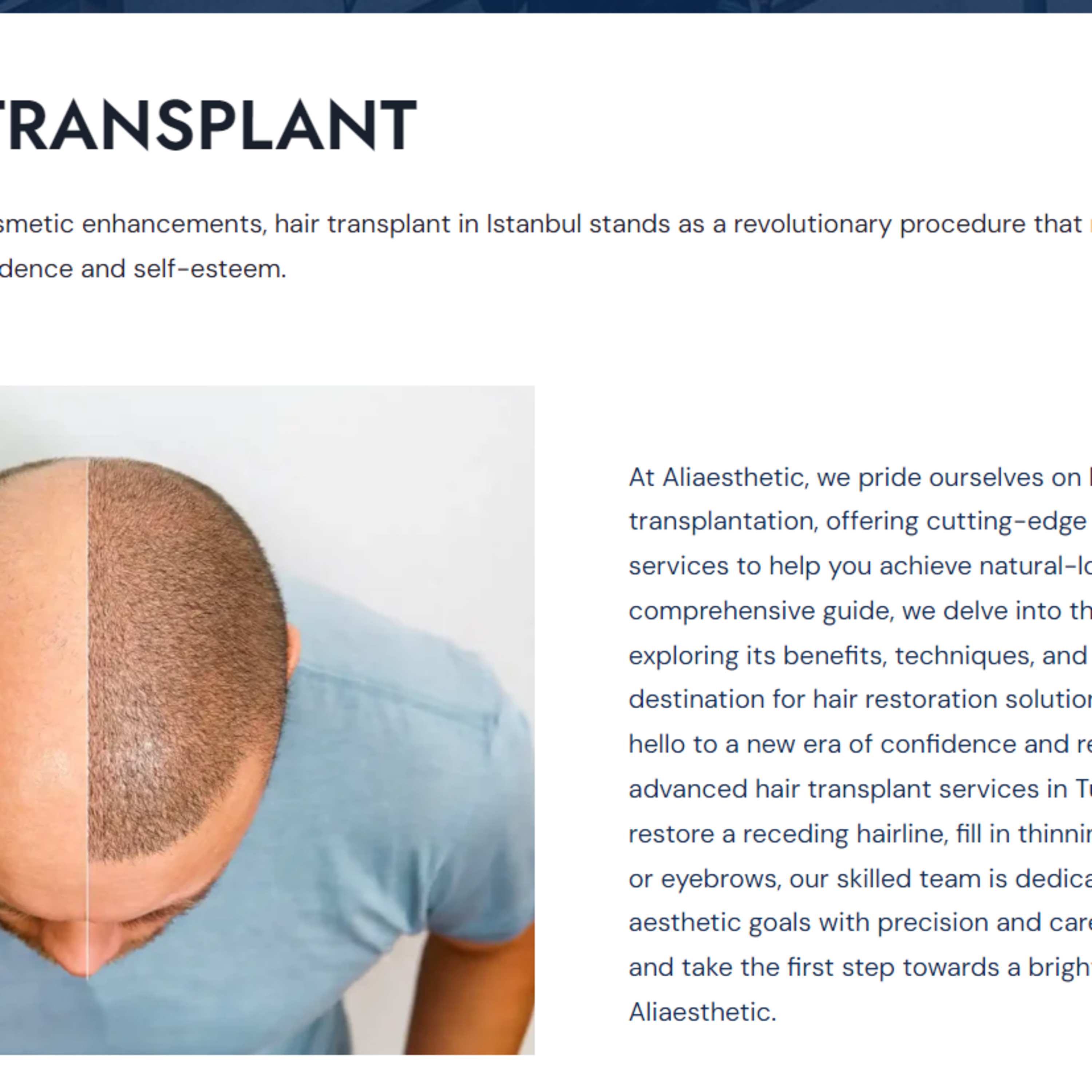 Hair transplant in istanbul episode artwork