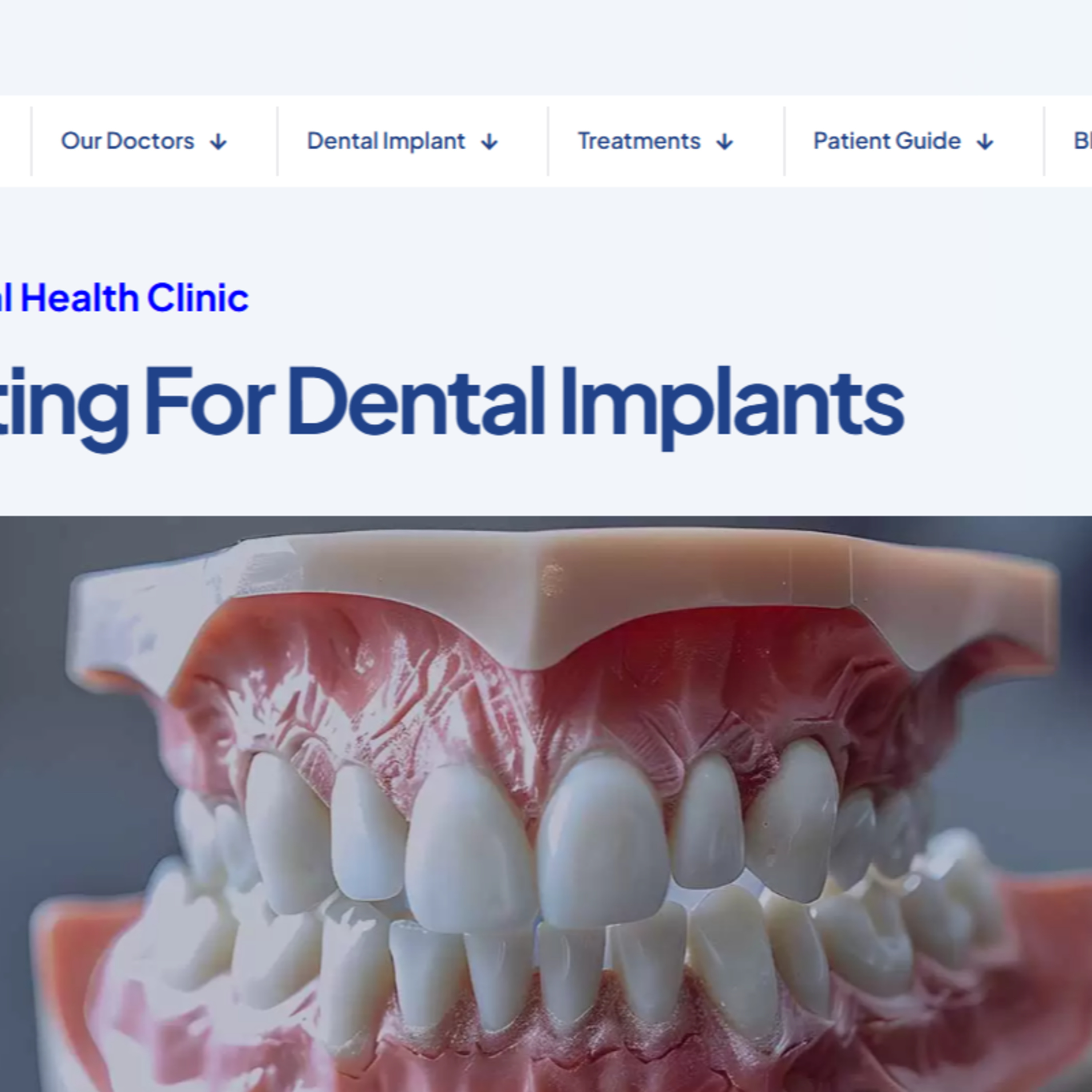 How Bone Grafting Enhances Implant Success Rates episode artwork