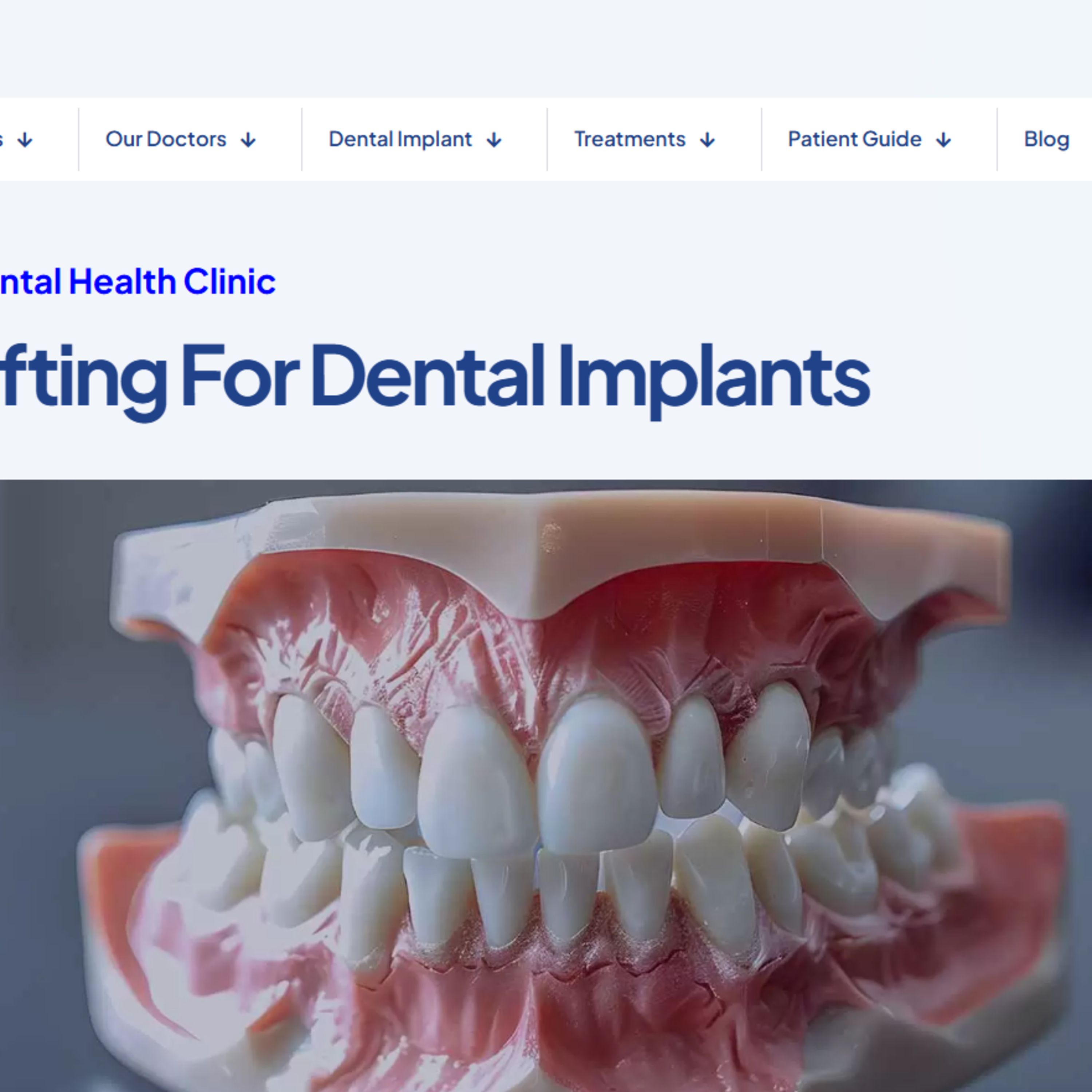 What Is Bone Grafting for Dental Implants? episode artwork