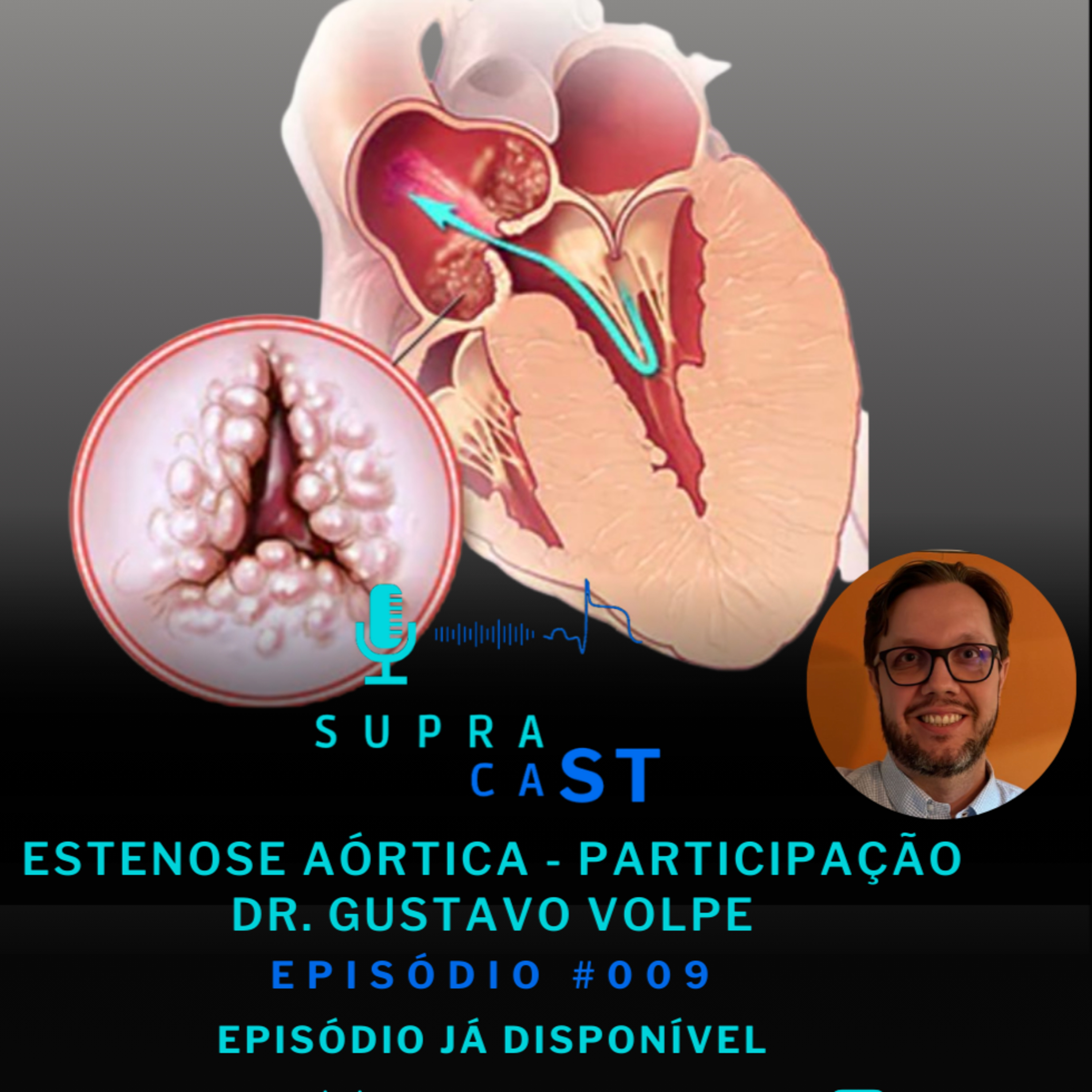 9. Estenose Aórtica episode artwork