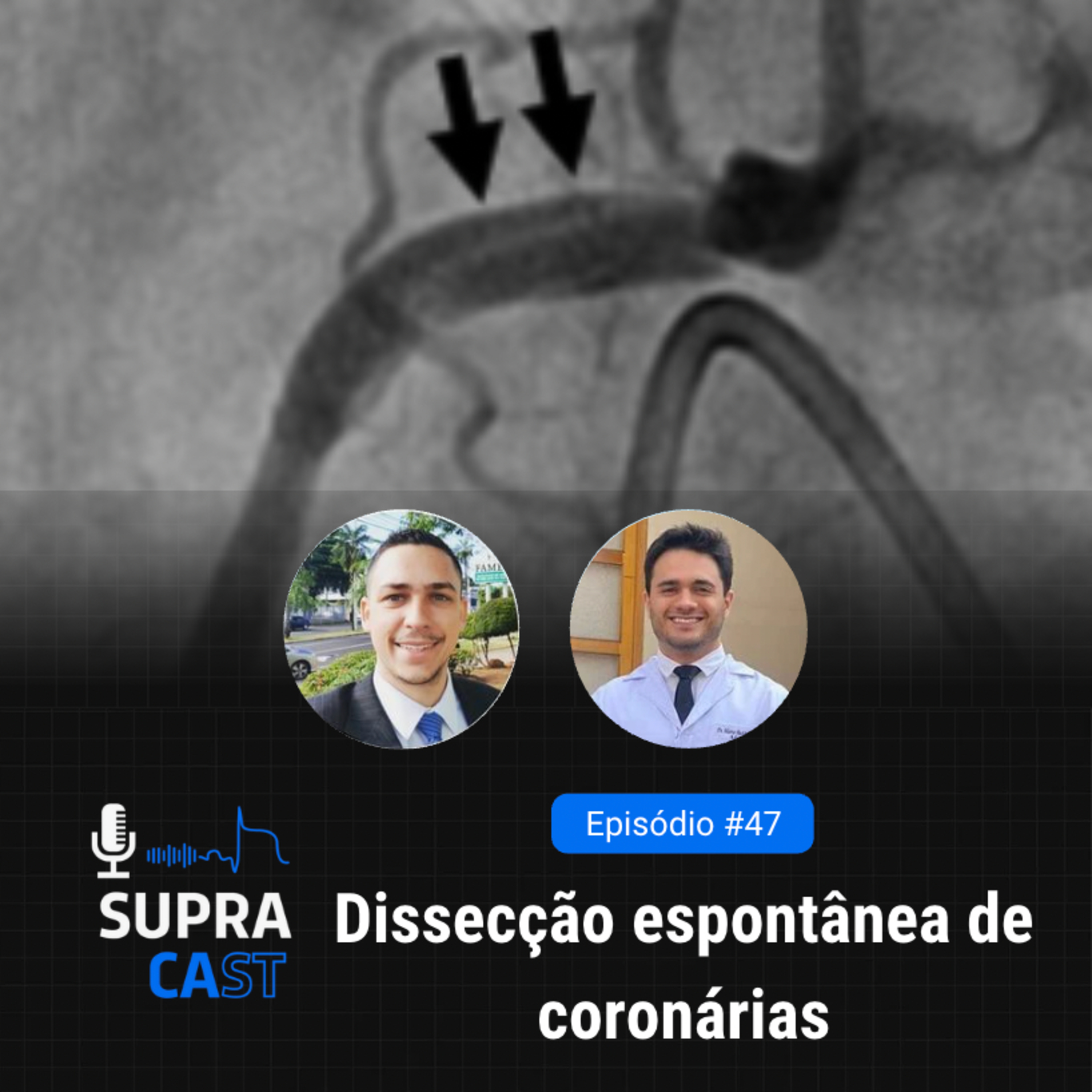 47. Dissecção Espontânea de Coronárias episode artwork