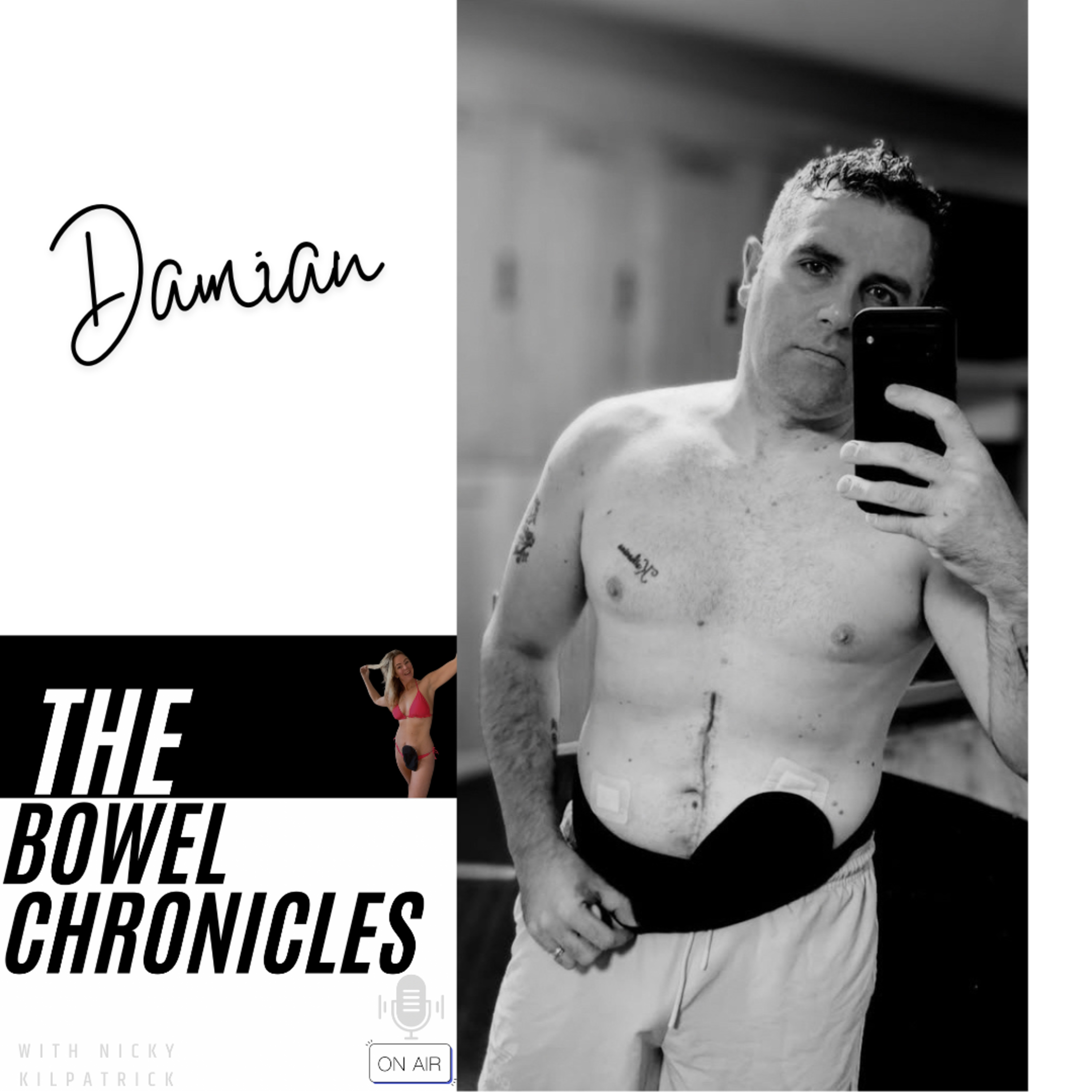 The Bowel Chronicles