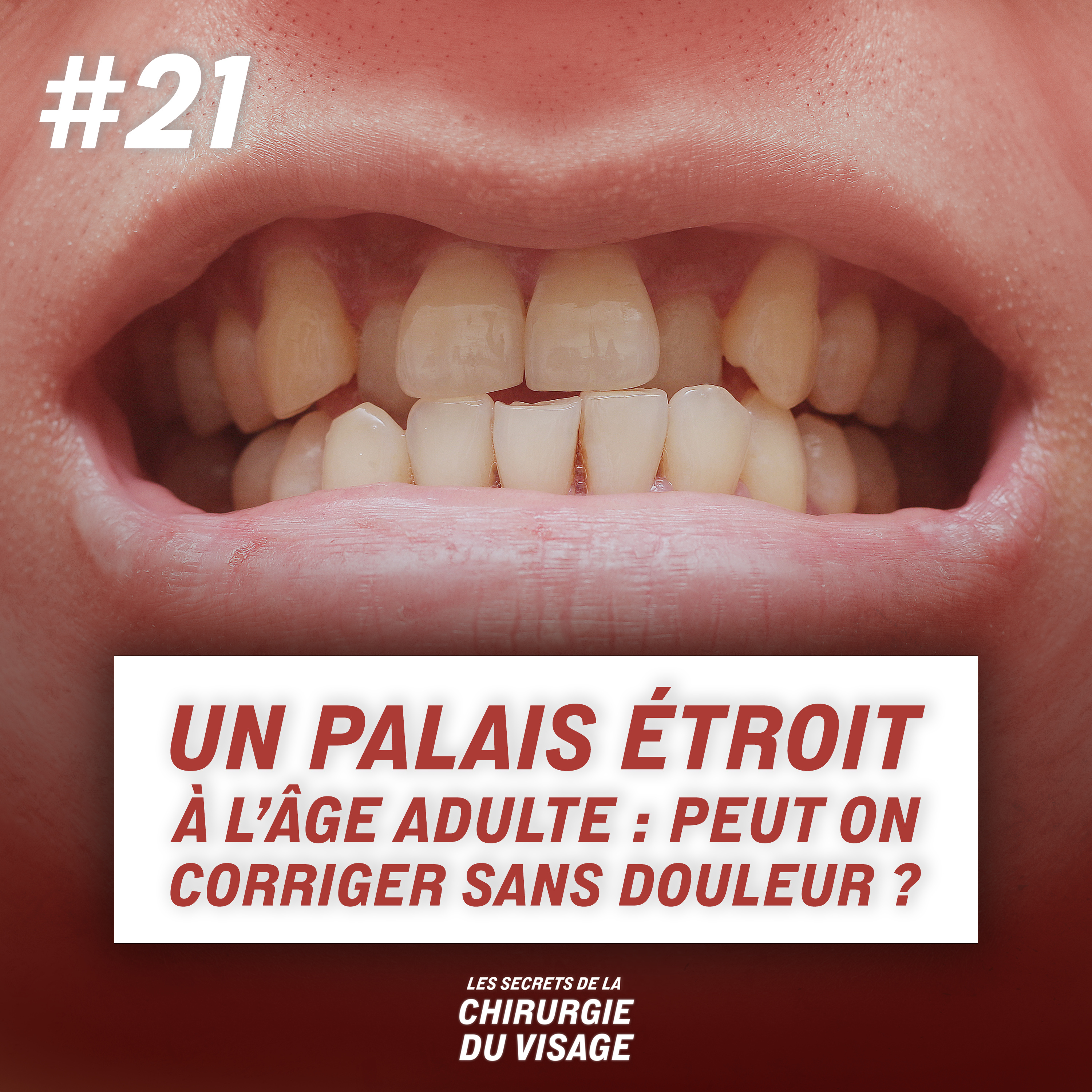 #21 - UN PALAIS ÉTROIT À L’ÂGE ADULTE : PEUT ON CORRIGER SANS DOULEUR ? episode artwork