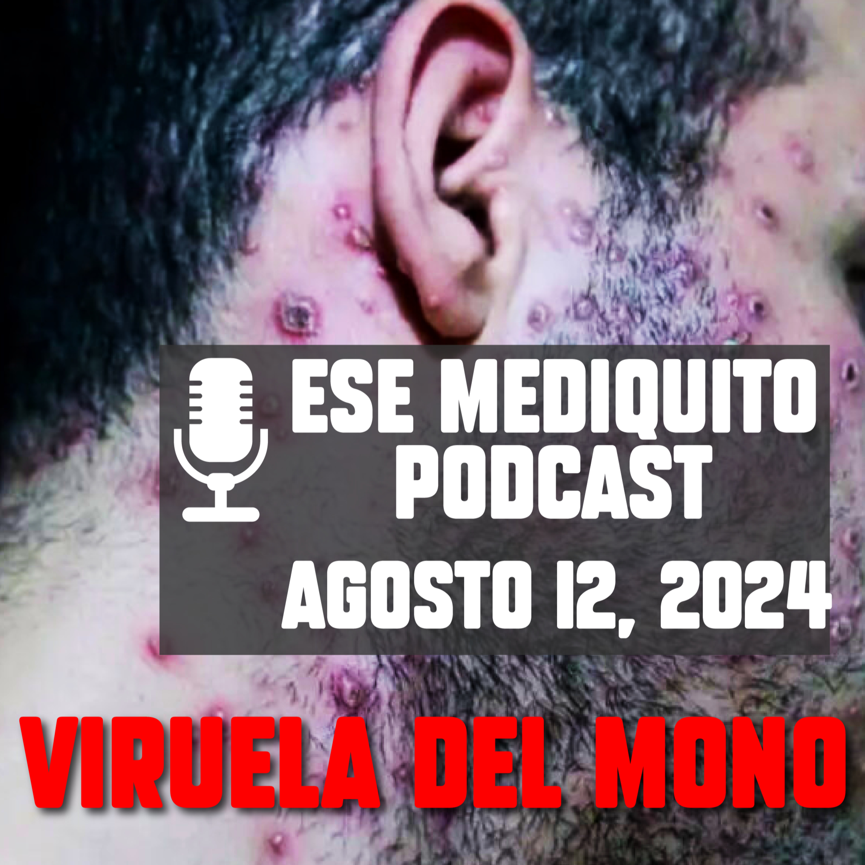 ¡ALERTA! VIRUELA del MONO ¿ES MORTAL? Todo lo que debes saber de la VIRUELA SÍMICA #mpox | E32 episode artwork