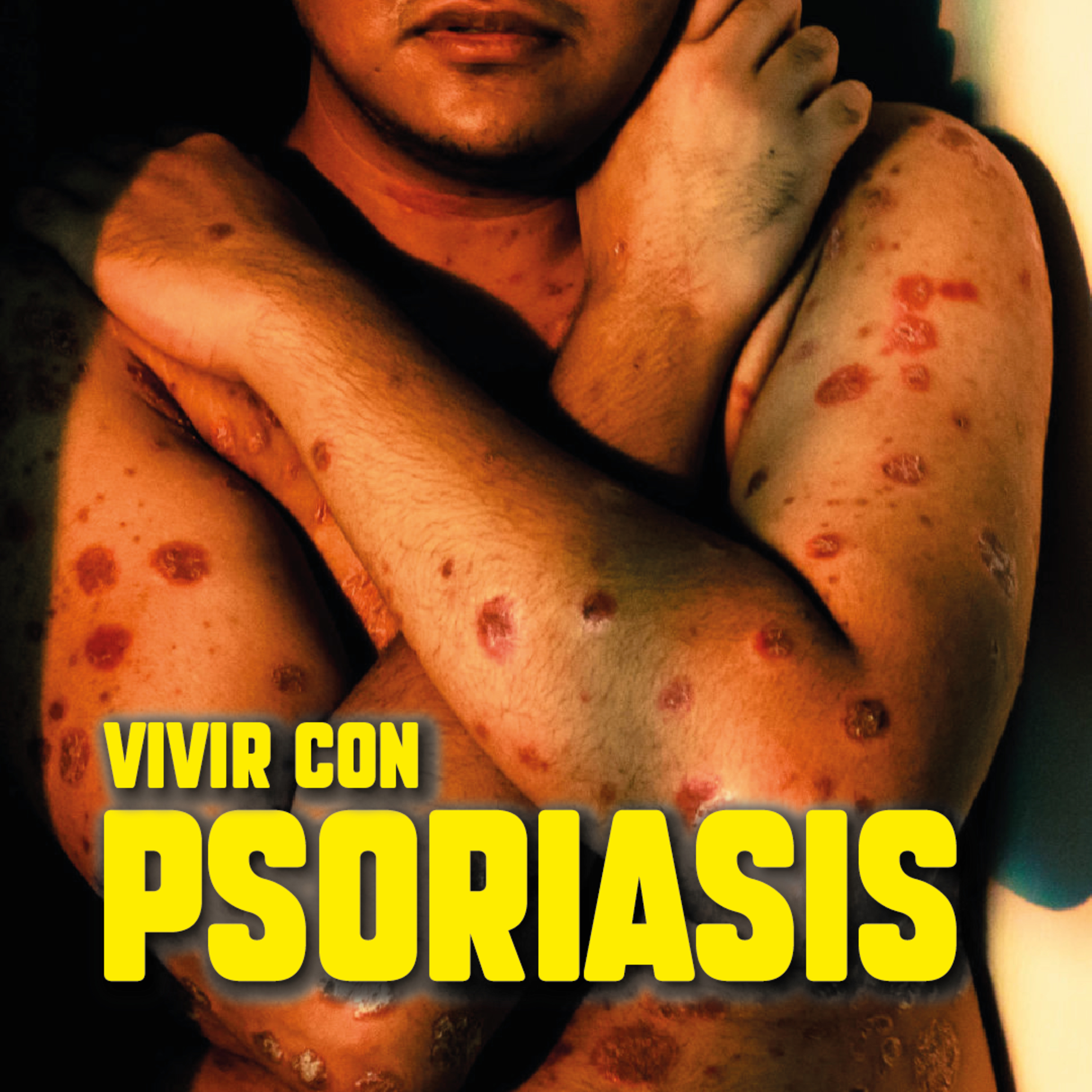 La VERDAD sobre la PSORIASIS que nadie te dice episode artwork