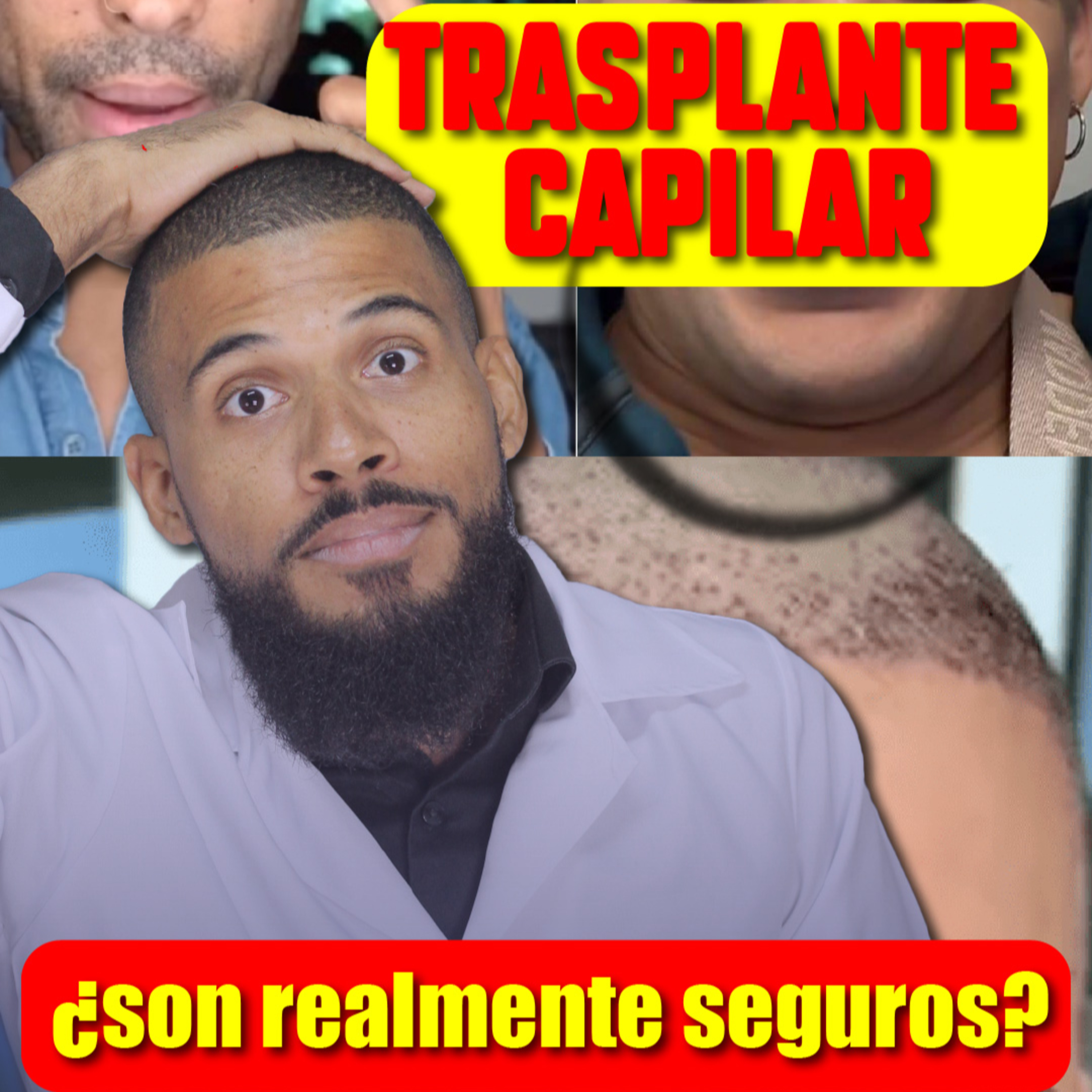 Trasplante capilar (o injerto): ¿Es peligroso? Riesgos y resultados REALES. TODO lo que DEBES Saber episode artwork