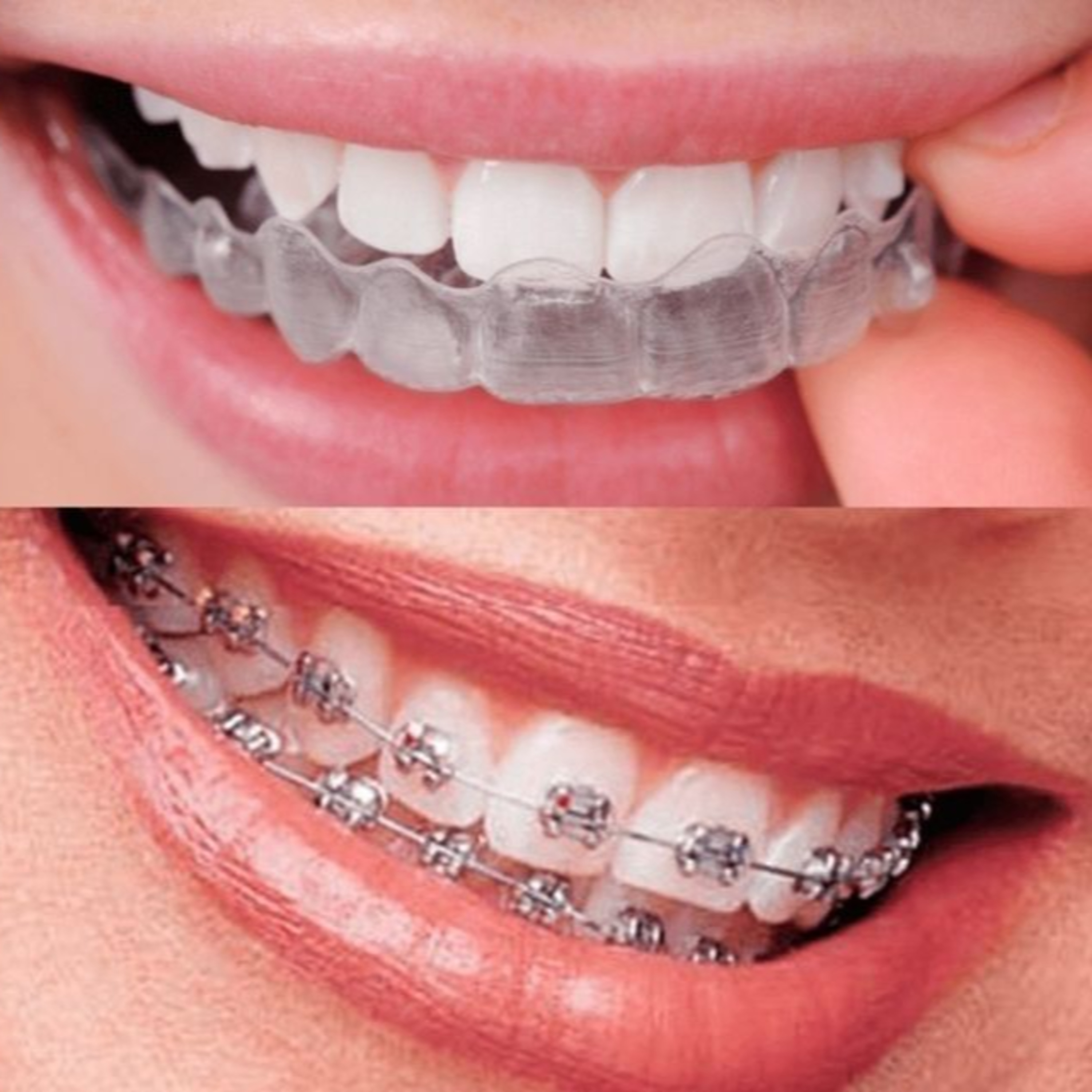 Braces vs Aligners: The Pain Truth You Didn’t Expect 😬🔥🦷 episode artwork