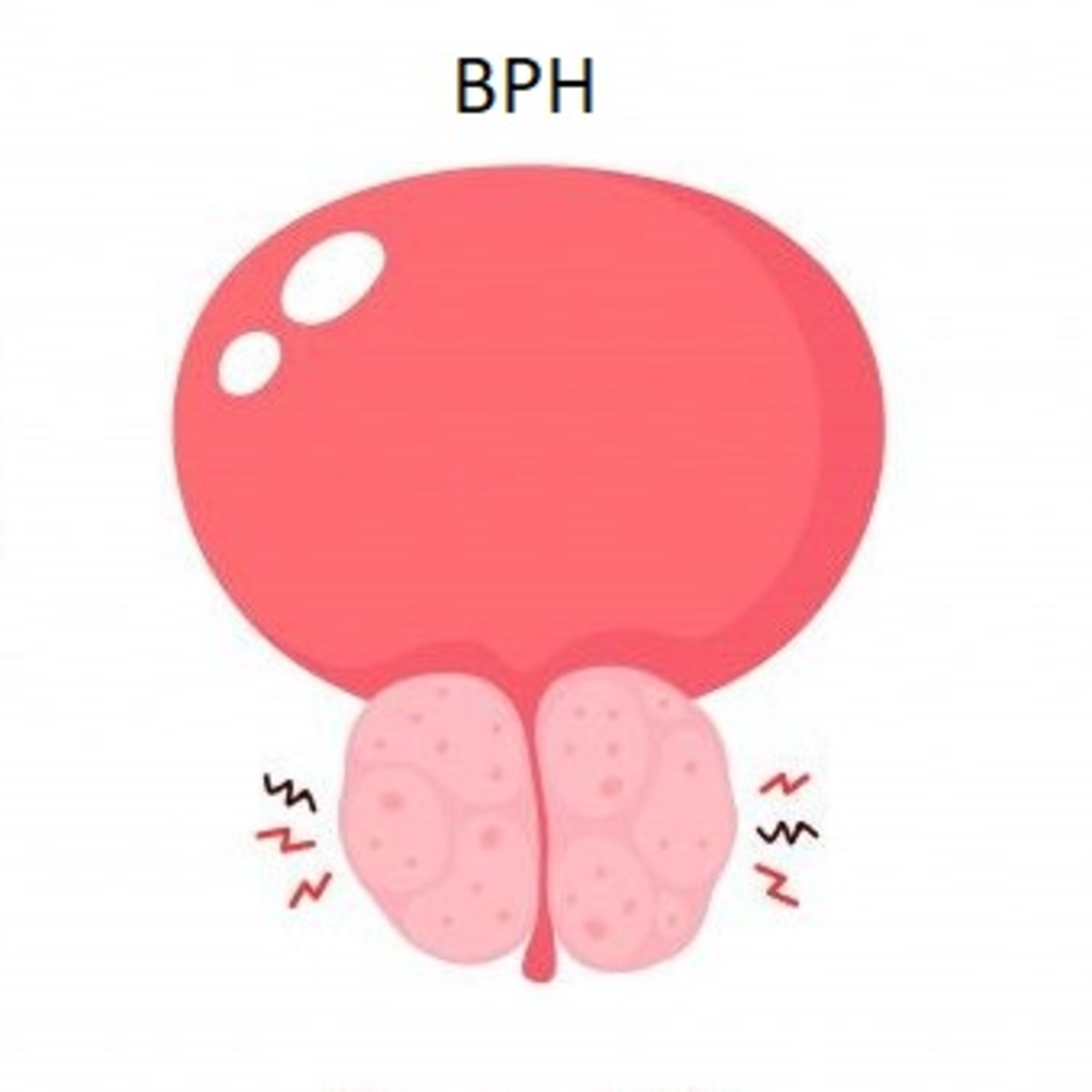 Men's Health - Part 1: Benign Prostatic Hyperplasia