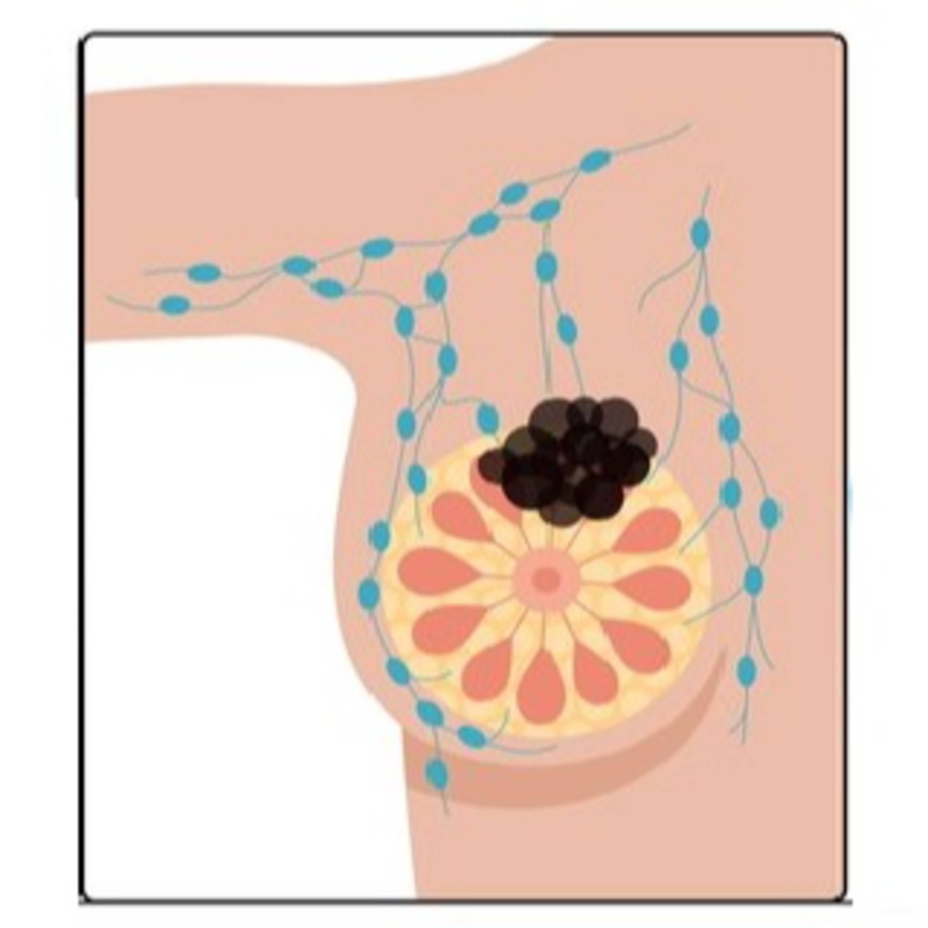 Women's Health - Part 3: Breast Cancer: Screening, Diagnosis, and Treatment