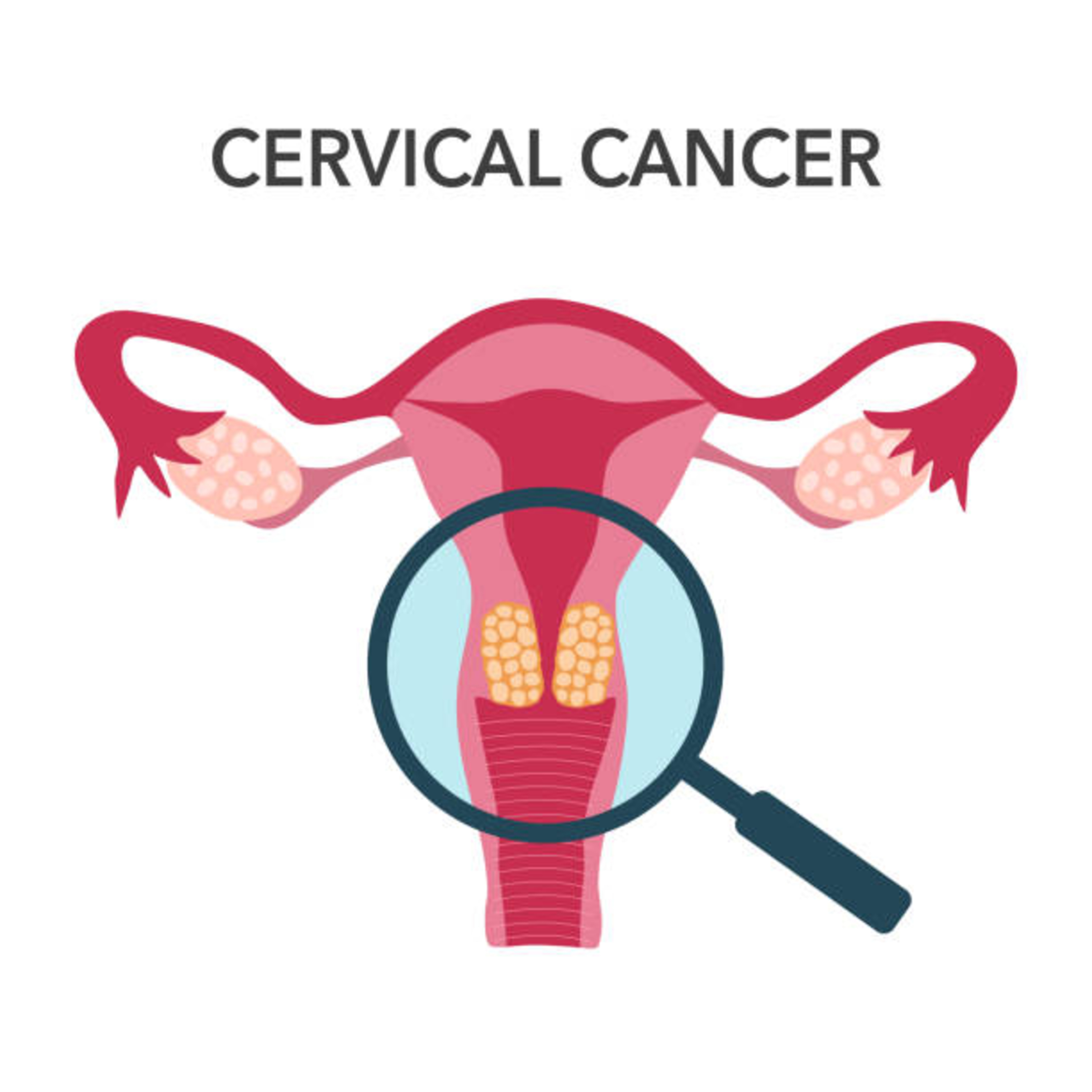 Women's Health - Part 2: Cervical Cancer Screening in Quebec