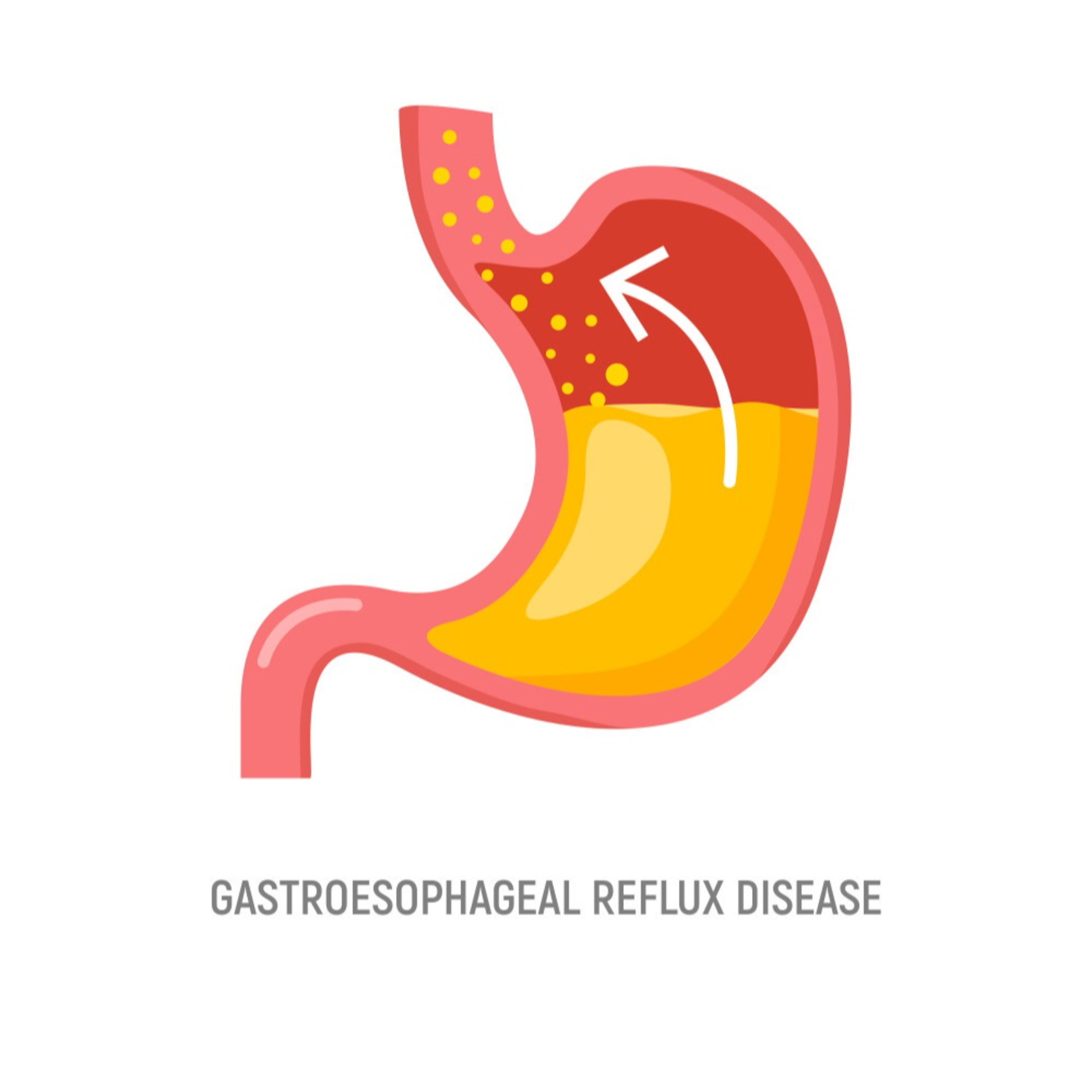 GI Issues - Part 1: Gastroesophageal Reflux Disease and Gastritis