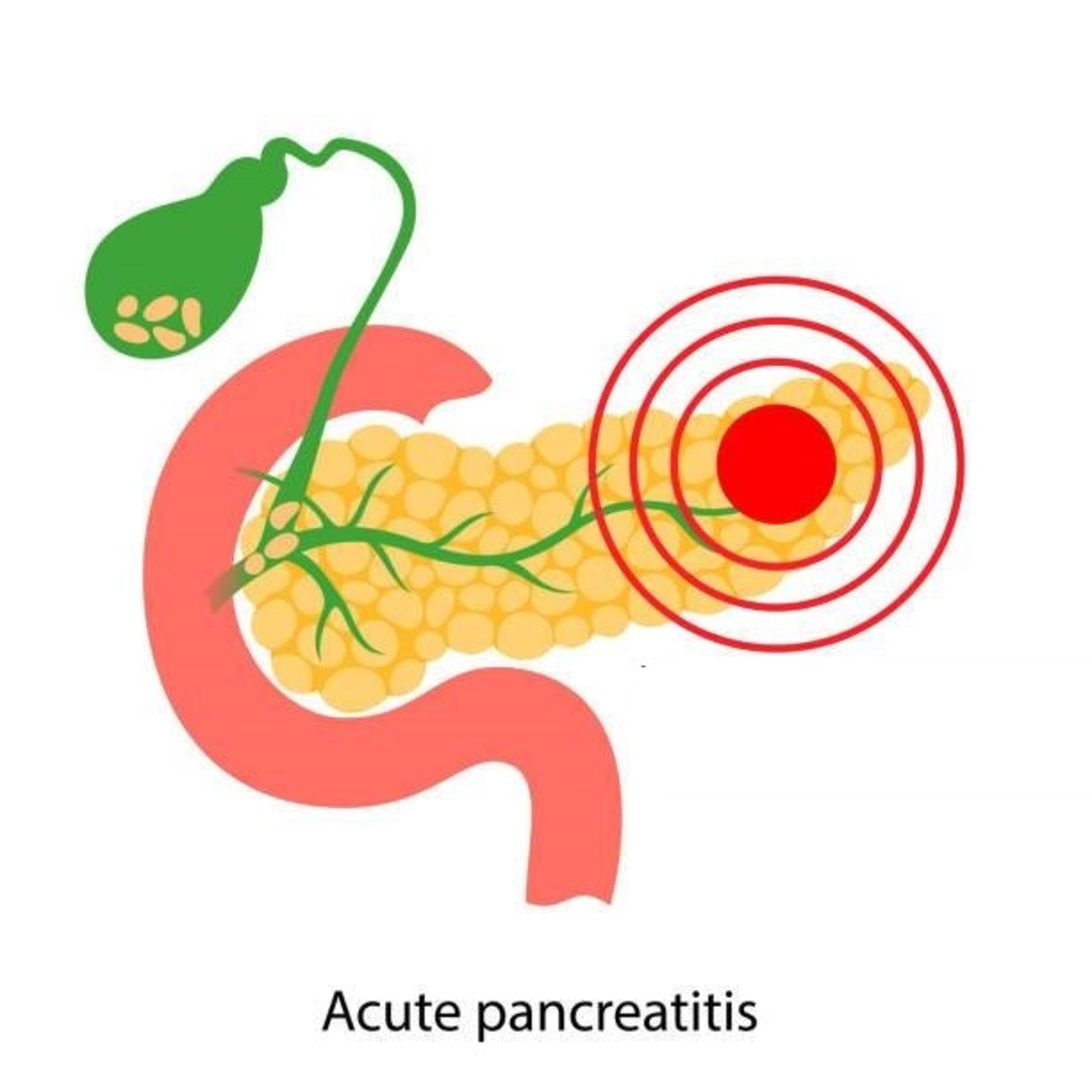 Pancreatitis