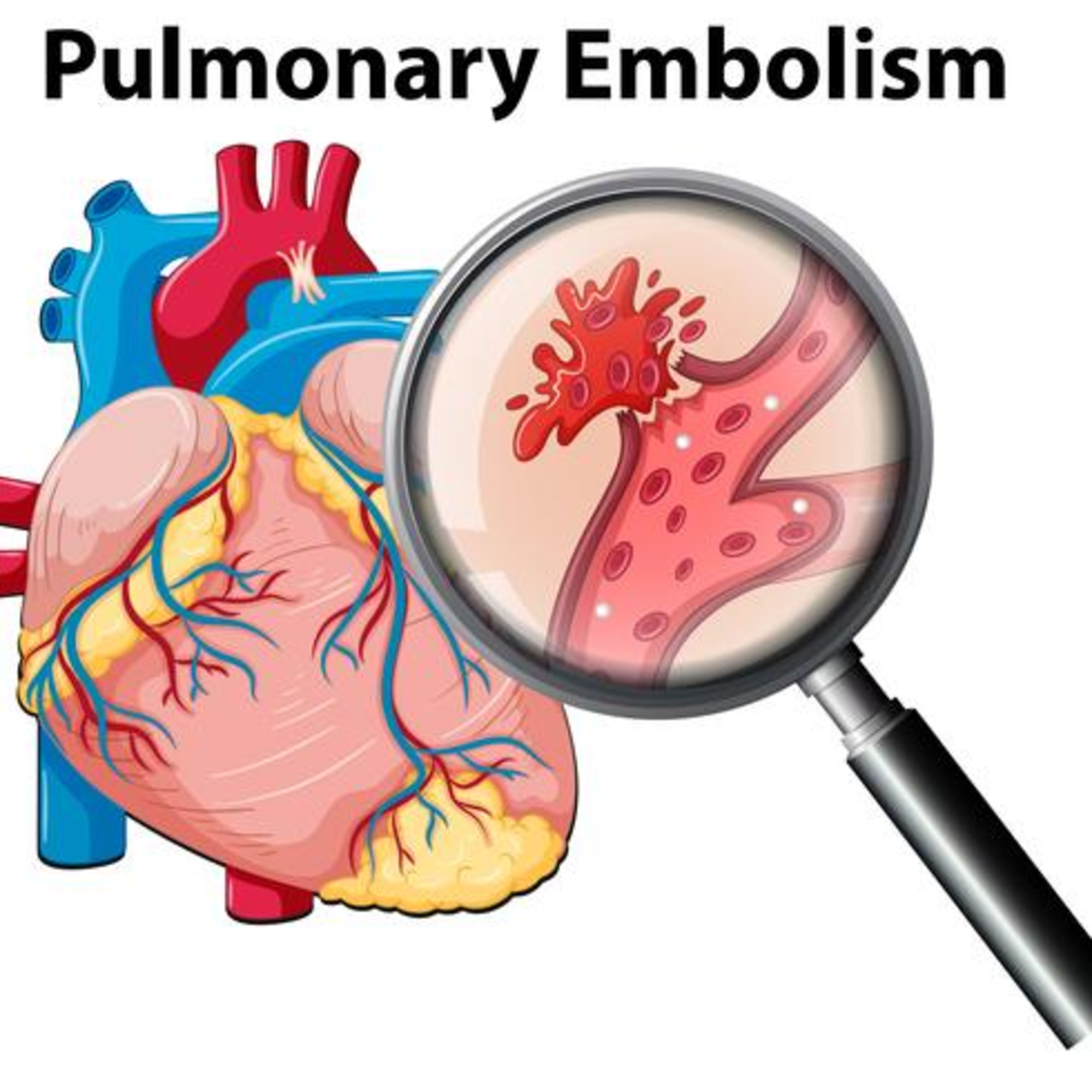 Anticoagulation Therapy and Venous Thromboembolism