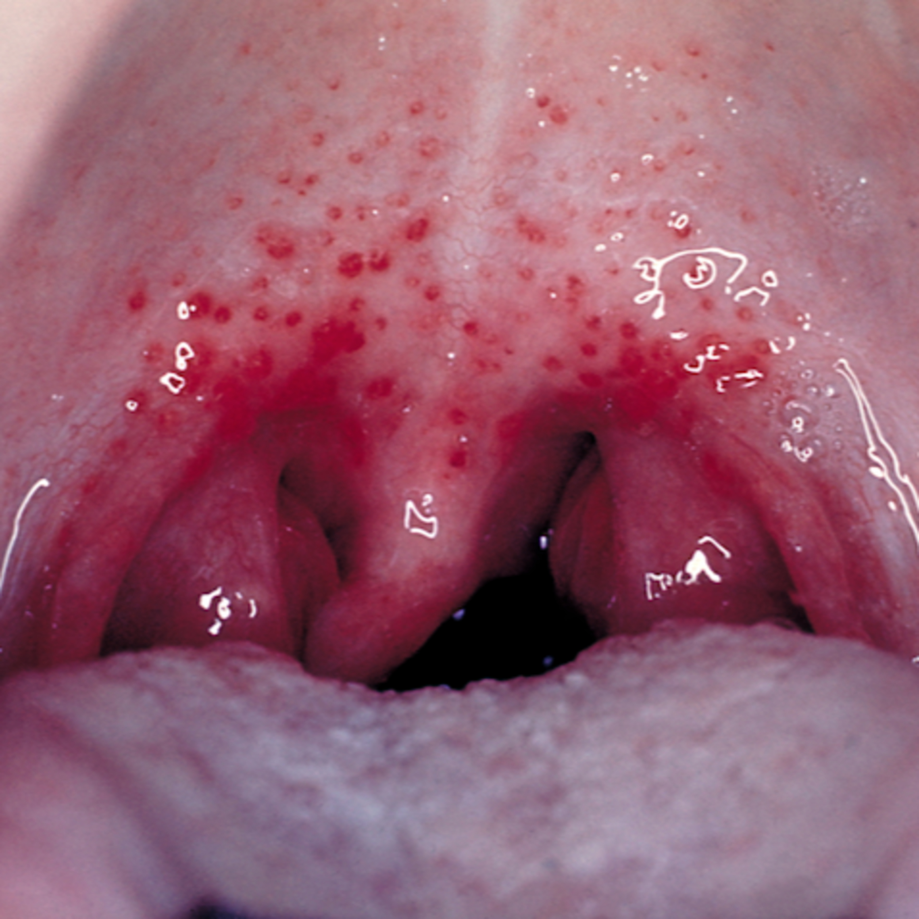 Ep 2: Strep Throat episode artwork