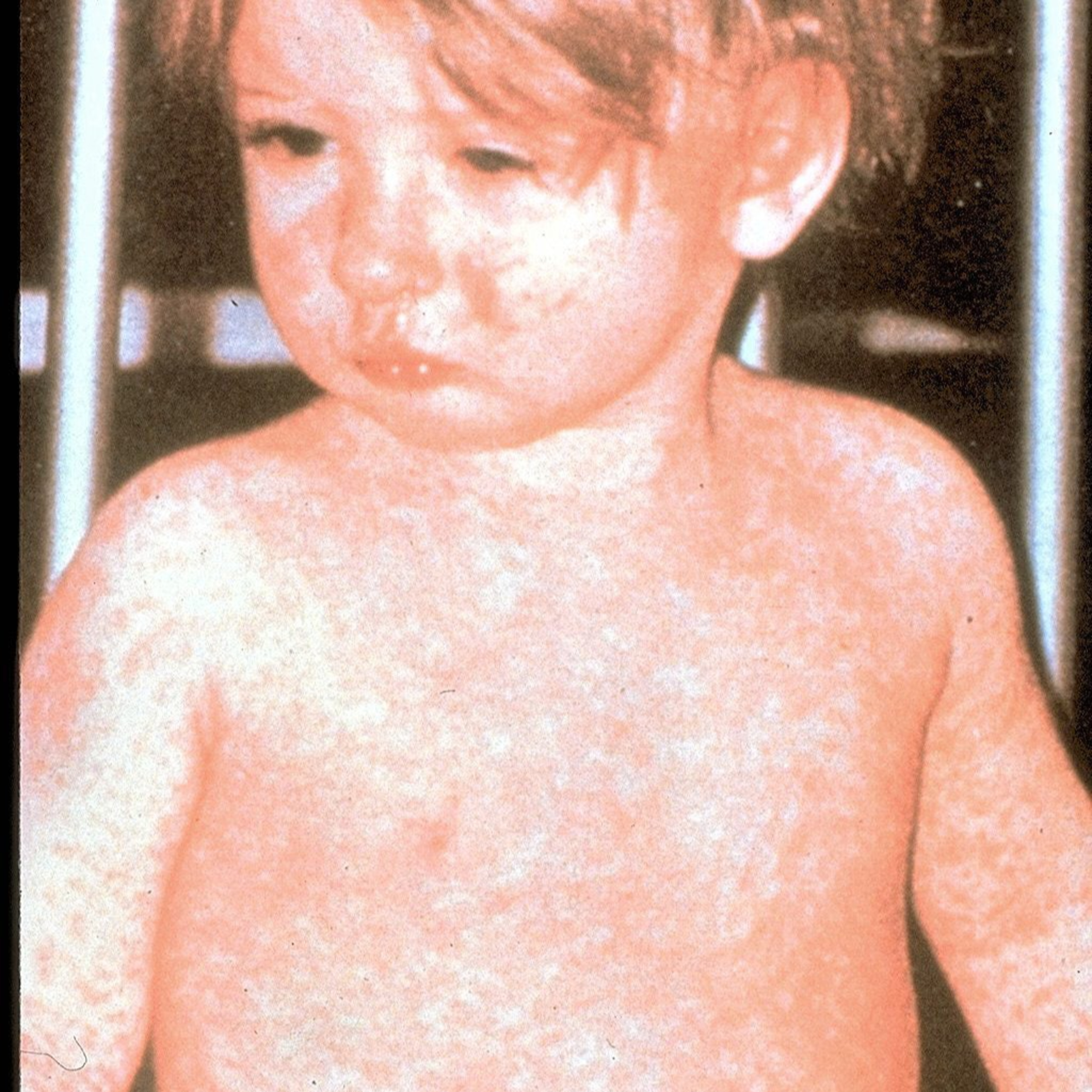 Ep 3: Measles! episode artwork